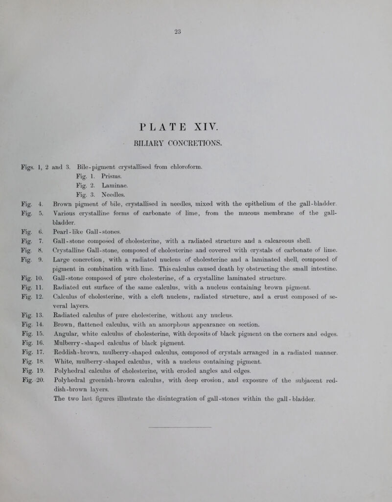 PLATE XIV. BILIARY CONCRETIONS. Figs. 1, 2 Fig. 4. Fig. 5. Fig. 6. Fig. 7. Fig. 8. Fig. 9. Fig. 10. Fig. 11. Fig. 12. Fig. 13. Fig. 14. Fig. 15. Fig. 1G. Fig. 17. Fig. 18. Fig. 19. Fig. 20. and 3. Bile-pigment crystallised from chloroform. Fig. 1. Prisms. © Fig. 2. Laminae. Fig. 3. Needles. Brown pigment of bile, crystallised in needles, mixed with the epithelium of the gall-bladder. Various crystalline forms of carbonate of lime, from the mucous membrane of the gall- bladder. Pearl-like Gall-stones. Gall-stone composed of cholesterine, with a radiated structure and a calcareous shell. Crystalline Gall-stone, composed of cholesterine and covered with crystals of carbonate of lime. Large concretion, with a radiated nucleus of cholesterine and a laminated shell, composed of pigment in combination with lime. This calculus caused death by obstructing the small intestine. Gall-stone composed of pure cholesterine, of a crystalline laminated structure. Radiated cut surface of the same calculus, with a nucleus containing brown pigment. Calculus of cholesterine, with a cleft nucleus, radiated structure, and a crust composed of se- veral layers. Radiated calculus of pure cholesterine, without any nucleus. Brown, flattened calculus, with an amorphous appearance on section. Angular, white calculus of cholesterine, with deposits of black pigment on the corners and edges. Mulberry - shaped calculus of black pigment. Reddish-brown, mulberry-shaped calculus, composed of crystals arranged in a radiated manner. White, mulberry-shaped calculus, with a nucleus containing pigment. Polyhedral calculus of cholesterine, with eroded angles and edges. Polyhedral greenish-brown calculus, with deep erosion, and exposure of the subjacent red- dish-brown layers. The two last figures illustrate the disintegration of gall-stones within the gall-bladder.