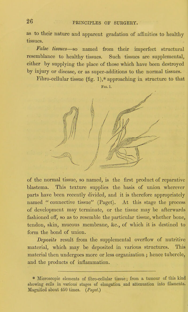 as to their nature and apparent gradation of affinities to healthy tissues. False tissues—so named from their imperfect structural resemblance to healthy tissues. Such tissues are supplemental, either by supplying the place of those which have been destroyed by injury or disease, or as super-additions to the normal tissues. Fibro-cellular tissue (fig. 1),* approaching in structure to that Fig. 1. of the normal tissue, so named, is the first product of reparative blastema. This texture supplies the basis of union wherever parts have been recently divided, and it is therefore appropriately named “ connective tissue^^ (Paget). At this stage the process of development may terminate, or the tissue may be afterwards fashioned off, so as to resemble the particular tissue, whether bone, tendon, skin, mucous membrane, &c., of which it is destined to form the bond of union. Deposits result from the supplemental overflow of nutritive material, which may be deposited in various structures. This material then undergoes more or less organization ; hence tubercle, and the products of inflammation. * Microscopic elements of libro-cellular tissue; from a tumour of tliis kind showing cells iu various' stages of elongation and attenuation into filaments. Magnified about 450 times. {Paget.)