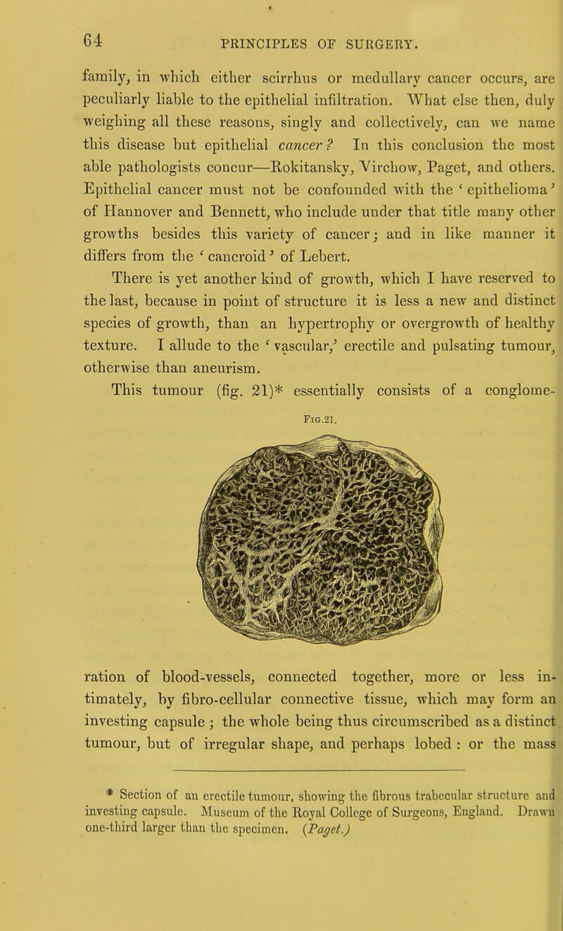 family, in which either scirrhus or medullary eancer occurs, are peeuliarly liable to the epithelial infiltration. What else then, duly weighing all these reasons, singly and eollectively, can we name this disease but epithelial cancer ? In this conclusion the most able pathologists eoncur—Rokitansky, Virchow, Paget, and others. Epithelial cancer must not be confounded with the ‘ epithelioma ’ of Hannover and Bennett, who include under that title many other growths besides this variety of cancer; and in like manner it differs from the ‘ eancroid ’ of Lebert. There is yet another kind of growth, which I have reserved to the last, because in point of strueture it is less a new and distinct species of growth, than an hypertrophy or overgrowth of healthy texture. I allude to the ^ vascular,^ erectile and pulsating tumour, otherwise than aneurism. This tumour (fig. 21)* essentially eonsists of a congloine- Fig.21. ration of blood-vessels, connected together, more or less in- timately, by fibro-cellular connective tissue, which may form an investing capsule ; the whole being thus circumscribed as a distinct, tumour, but of irregular shape, and perhaps lobed : or the mass * Section of an erectile tumour, showing the fibrous trabecular structure and investing capsule. Museum of the Royal College of Surgeons, England. Drawn one-third larger than the specimen. (Paget.)