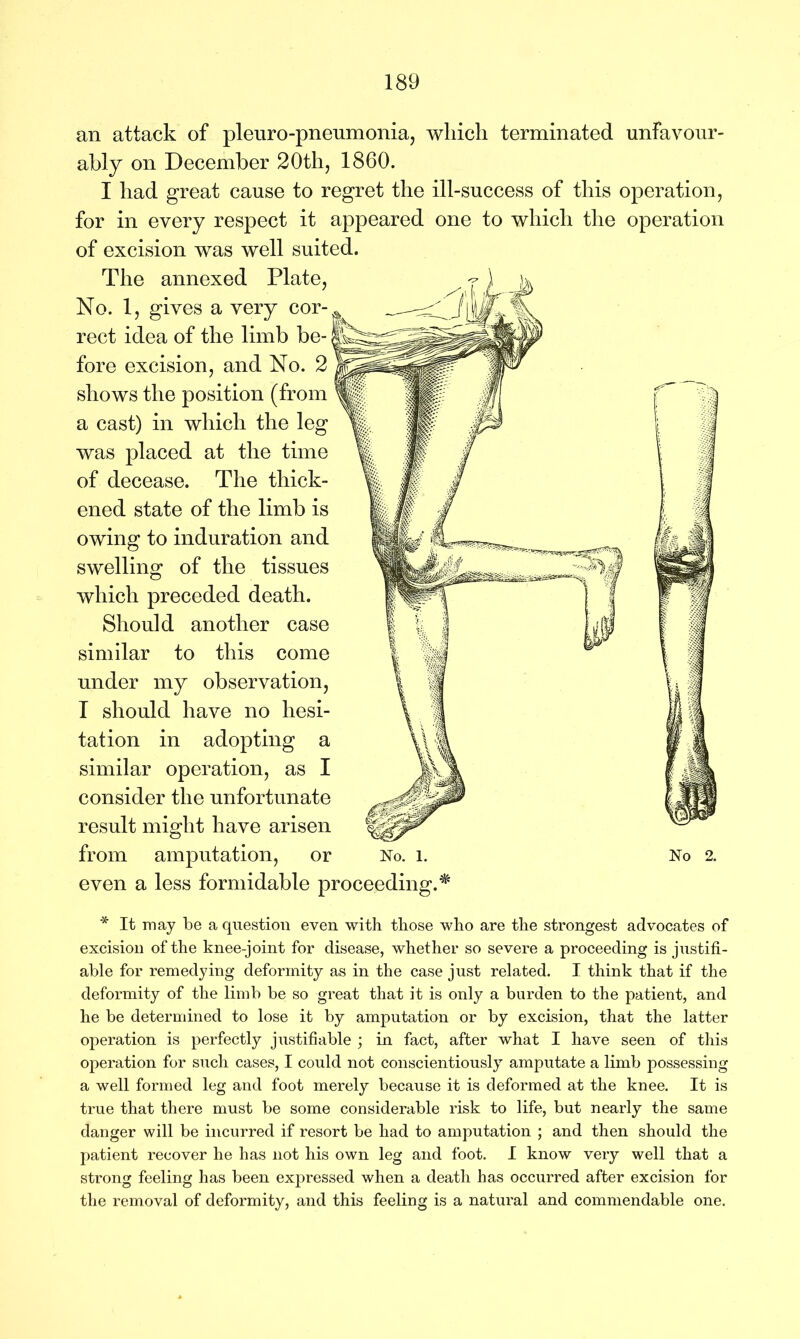 an attack of pleuro-pneumonia, which terminated unfavour- ably on December 20th, 1860. I had great cause to regret the ill-success of this operation, for in every respect it appeared one to which the operation of excision was well suited. The annexed Plate, No. 1, gives a very cor- rect idea of the limb be- fore excision, and No. 2 shows the position (from a cast) in which the leg was placed at the time of decease. The thick- ened state of the limb is owing to induration and swelling of the tissues which preceded death. Should another case similar to this come under my observation, I should have no hesi- tation in adopting a similar operation, as I consider the unfortunate result might have arisen from amputation, or No. l. No 2. even a less formidable proceeding.* * It may be a question even with those who are the strongest advocates of excision of the knee-joint for disease, whether so severe a proceeding is justifi- able for remedying deformity as in the case just related. I think that if the deformity of the limb be so great that it is only a burden to the patient, and he be determined to lose it by amputation or by excision, that the latter operation is perfectly justifiable ; in fact, after what I have seen of this operation for such cases, I could not conscientiously amputate a limb possessing a well formed leg and foot merely because it is deformed at the knee. It is true that there must be some considerable risk to life, but nearly the same danger will be incurred if resort be had to amputation ; and then should the patient recover he has not his own leg and foot. I know very well that a strong feeling has been expressed when a death has occurred after excision for the removal of deformity, and this feeling is a natural and commendable one.