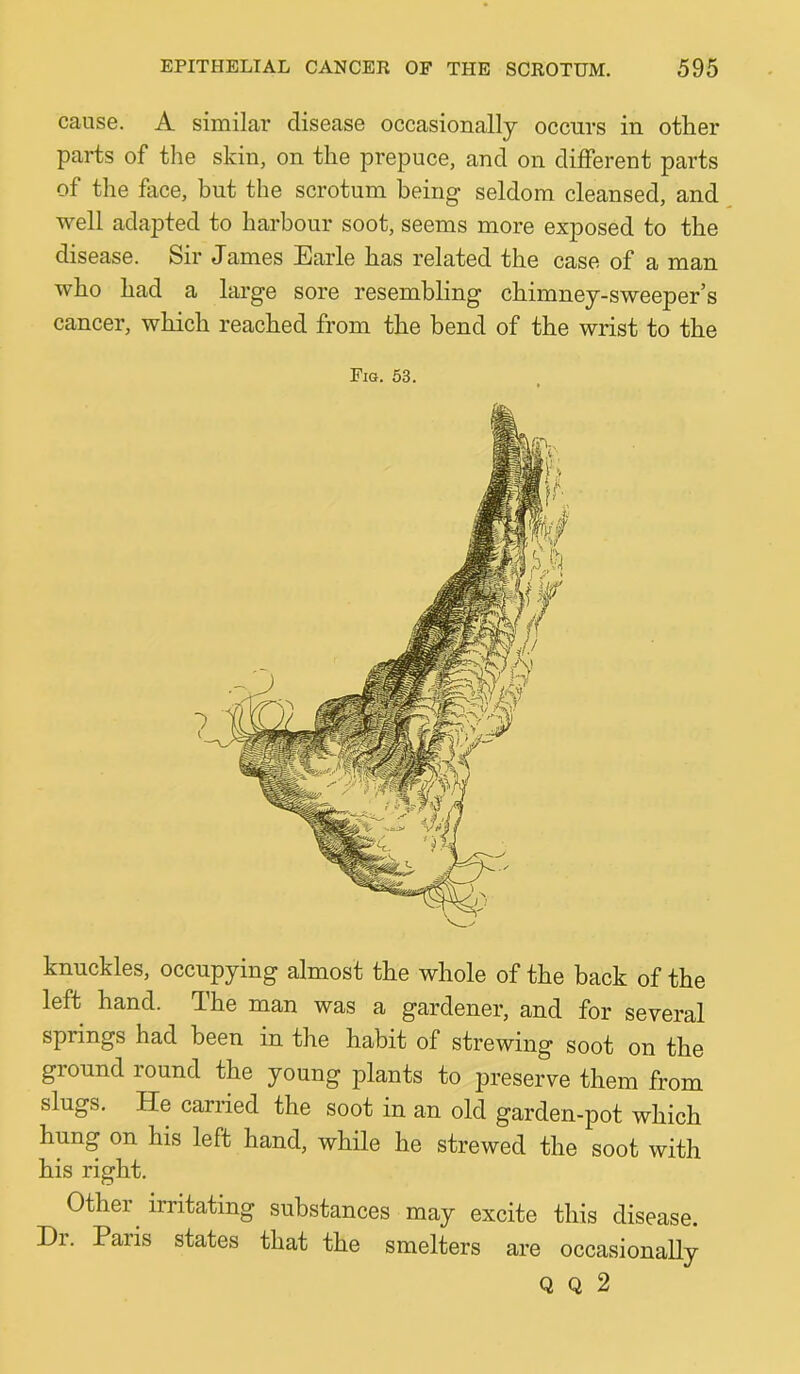 cause. A similar disease occasionally occurs in other parts of the skin, on the prepuce, and on different parts of the face, but the scrotum being seldom cleansed, and well adapted to harbour soot, seems more exposed to the disease. Sir James Earle has related the case of a man who had a large sore resembling chimney-sweeper’s cancer, which reached from the bend of the wrist to the Fio. 53. knuckles, occupying almost the whole of the back of the left hand. The man was a gardener, and for several springs had been in the habit of strewing soot on the ground lound the young plants to preserve them from slugs. He carried the soot in an old garden-pot which hung on his left hand, while he strewed the soot with his right. Other irritating substances may excite this disease. Di. Paris states that the smelters are occasionally Q Q 2