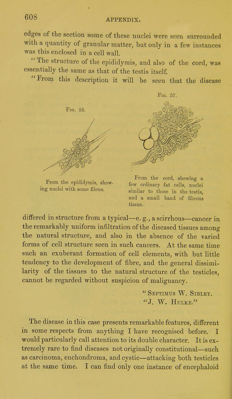 APPENDIX. edges of the section some of these nuclei were seen surrounded with a quantity of granular matter^ but only in a few instances was this enclosed in a cell wall. The structure of the epididymis, and also of the cord, was essentially the same as that of the testis itself. From this description it will be seen that the disease Fig. 57. Fig. 56. From the epididymis, show- ing nuclei with some fibres. From the cord, showing a few ordinary fat cells, nuclei similar to those in the testis, and a small hand of fibrous tissue. differed in structure from a typical—e. g., a scirrhous—cancer in the remarkably uniform infiltration of the diseased tissues among the natural structure, and also in the absence of the varied forms of cell structure seen in such cancers. At the same time such an exuberant formation of cell elements, with but little tendency to the development of fibre, and the general dissimi- larity of the tissues to the natural structure of the testicles, cannot be regarded without suspicion of malignancy. “ Septimus W. Sibley. “J. W. Hulke.^^ The disease in this case presents remarkable features, different in some respects from anything I have recognised before. I would particularly call attention to its double character. It is ex- tremely rare to find diseases not originally constitutional—such as carcinoma, enchondroma, and cystic—attacking both testicles at the same time. I can find only one instance of encephaloid