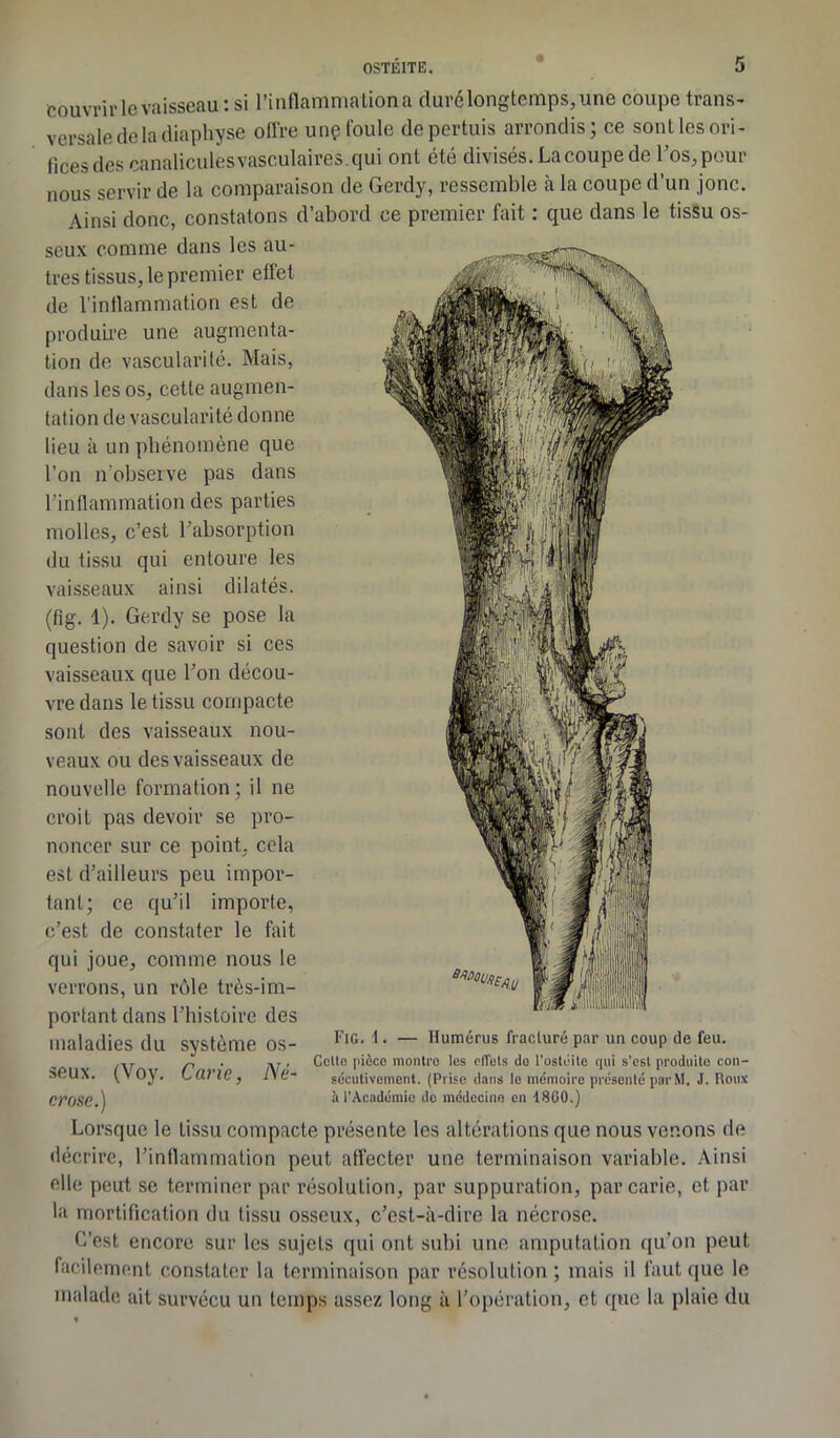 couvrir le vaisseau : si l'inflamma tion a duré longtemps, une coupe trans- versale de la diaphyse offre unç foule depertuis arrondis; ce sont les ori- fices des canalicules vasculaires, qui ont été divisés. La coupe de l’os, pour nous servir de la comparaison de Gerdy, ressemble à la coupe d’un jonc. Ainsi donc, constatons d’abord ce premier fait : que dans le tissu os- seux comme dans les au- tres tissus, le premier effet de l’inflammation est de produire une augmenta- tion de vascularité. Mais, dans les os, cette augmen- tation de vascularité donne lieu à un phénomène que l’on n’observe pas dans l'inflammation des parties molles, c’est l’absorption du tissu qui entoure les vaisseaux ainsi dilatés. (fig. 1). Gerdy se pose la question de savoir si ces vaisseaux que l’on décou- vre dans le tissu compacte sont des vaisseaux nou- veaux ou des vaisseaux de nouvelle formation; il ne croit pas devoir se pro- noncer sur ce point, cela est d’ailleurs peu impor- tant; ce qu’il importe, c’est de constater le fait qui joue, comme nous le Fig. 1. — Humérus fracturé par un coup de feu. Colle pièce montre les effets do l’ostéite (pii s'esl produite con- sécutivement. (Prise dans le mémoire présenté par M, J. Roux à l'Académie de médecine en i8G0.) verrons, un rôle très-im- portant dans l’histoire des maladies du système os- seux. (Voy. Carie, Né- crose.) Lorsque le tissu compacte présente les altérations que nous venons de décrire, l’inflammation peut affecter une terminaison variable. Ainsi elle peut se terminer par résolution, par suppuration, par carie, et par la mortification du tissu osseux, c’est-à-dire la nécrose. C’est encore sur les sujets qui ont subi une amputation qu’on peut facilement constater la terminaison par résolution ; mais il faut que le malade ait survécu un temps assez long à l’opération, et que la plaie du