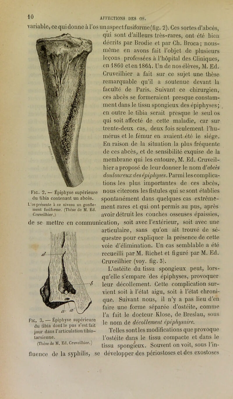 variable, ce qui donne à l’os unaspectfusiforme(fig. 2). Ces sortes d’abcès, qui sont d’ailleurs très-rares, ont été bien décrits par Brodie et par Ch. Broca; nous- méme en avons fait l’objet de plusieurs leçons professées à l’hôpital des Cliniques, en 1860 et en 1864. Un de nos élèves, M. Ed. Cruveilhier a fait sur ce sujet une thèse remarquable qu’il a soutenue devant la faculté de Paris. Suivant ce chirurgien, ces abcès se formeraient presque constam- ment dans le tissu spongieux des épiphyses; en outre le tibia serait presque le seul os qui soit affecté de cette maladie, car sur trente-deux cas, deux fois seulement l’hu- mérus et le fémur en avaient été le siège. En raison de la situation la plus fréquente de ces abcès, et de sensibilité exquise de la membrane qui les entoure, M. Ed. Cruveil- hier a proposé de leur donner le nom d’abcès douloureux des épiphyses. Parmi les complica- tions les plus importantes de ces abcès, nous citerons les fistules qui se sont établies spontanément dans quelques cas extrême- ment rares et qui ont permis au pus, après avoir détruit les couches osseuses épaissies, de se mettre en communication, soit avec l’extérieur, soit avec une articulaire, sans qu’on ait trouvé de sé- questre pour expliquer la présence de cette voie d’élimination. Un cas semblable a été recueilli par M. Richet et figuré par M. Ed. Cruveilhier (voy. fig. 3). I/ostéite du tissu spongieux peut, lors- qu’elle s’empare des épiphyses, provoquer leur décollement. Cette complication sur- vient soit à l’état aigu, soit à l’état chroni- que. Suivant nous, il n’y a pas lieu d’en faire une forme séparée d’ostéite, comme l’a fait le docteur Klose, de Breslau, sous le nom de décollement épiphysaire. Telles sontlcs modifications que provoque l’ostéite dans le tissu compacte et dans le tissu spongieux. Souvent on voit, sous 1 in- fluence de la syphilis, se développer des périostoses et des exostoses Fig. 2. — Épiphyse supérieure du tibia contenant un abcès. L'os présente à ce niveau un gonfle- ment fusiforme. (Thèse de M. Ed. Cruveilhier.) Fig. 3. — Épiphyse supérieure du tibia dont le pus s’est fait jour dans l’articulation tibio— tarsienne. (Thèsede M. Ed. Cruvcilhior.)