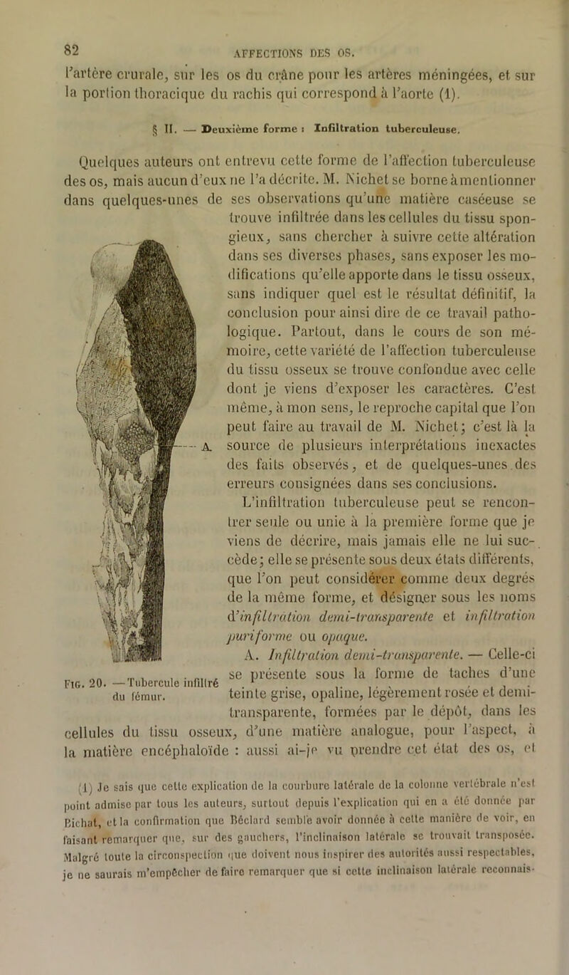 l'avtcre crurale, sur les os du crâne pour les artères méningées, et sur la portion thoracique du rachis qui correspond à l'aorte (1). § II. — Deuxième forme i Infiltration tuberculeuse. Quelques auteurs ont entrevu cette forme de l'affection tuberculeuse des os, mais aucun d’eux ne l’a décrite. M. Nichet se borne àmenlionner dans quelques-unes de ses observations qu’une matière caséeuse se trouve infiltrée dans les cellules du tissu spon- gieux, sans chercher à suivre cette altération dans ses diverses phases, sans exposer les mo- difications qu'elle apporte dans le tissu osseux, sans indiquer quel est le résultat définitif, la conclusion pour ainsi dire de ce travail patho- logique. Partout, dans le cours de son mé- moire, cette variété de l’affection tuberculeuse du tissu osseux se trouve confondue avec celle dont je viens d'exposer les caractères. C’est même, à mon sens, le reproche capital que l’on peut faire au travail de M. Nichet; c'est là la source de plusieurs interprétations inexactes des faits observés, et de quelques-unes des erreurs consignées dans ses conclusions. L’infiltration tuberculeuse peut se rencon- trer seule ou unie à la première forme que je viens de décrire, mais jamais elle ne lui suc- cède; elle se présente sous deux états différents, que l'on peut considérer comme deux degrés de la même forme, et désigner sous les noms à!infiltration demi-transparente et infiltration puriforme ou opaque. A. Infiltration demi-transpurenle. — Celle-ci , se présente sous la forme de taches d’une Fig. 20. —Tubercule infiltré . 1 . , , , , . , du fémur. teinte grise, opaline, legerement rosee et denu- transparente, formées par le dépôt, dans les cellules du tissu osseux, d'une matière analogue, pour 1 aspect, a la matière encéphaloïde : aussi ai-je vu prendre cet état des os, et ,'l) Je sais que cette explication de lu courbure latérale de la colonne vertébrale n’est point admise par tous les auteurs, surtout depuis l’explication qui en a été donnée par Bichat, et la confirmation que Réclard semble avoir donnée à cette manière de voir, en faisant remarquer que, sur des gauchers, l’inclinaison latérale se trouvait transposée. Malgré toute la circonspection que doivent nous inspirer des autorités aussi respectables, je ne saurais m’empêcher defairo remarquer que si cette inclinaison latérale reconnais-