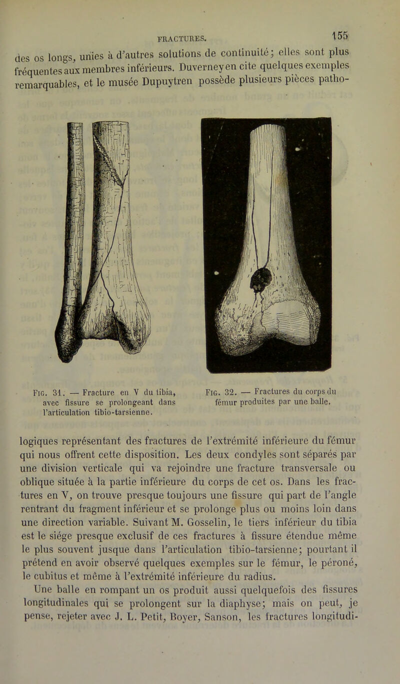 des os longs, unies à d’autres solutions de continuité; elles sont plus fréquentes aux membres inférieurs. Duverneyen cite quelques exemples remarquables, et le musée Dupuytren possède plusieurs pièces patlio- FiG. 31. — Fracture en V du libia, avec fissure se prolongeant dans l’articulation tibio-tarsienne. Fig. 32. — Fractures du corps du fémur produites par une balle. logiques représentant des fractures de l’extrémité inférieure du fémur qui nous offrent cette disposition. Les deux condyles sont séparés par une division verticale qui va rejoindre une fracture transversale ou oblique située à la partie inférieure du corps de cet os. Dans les frac- tures en Y, on trouve presque toujours une fissure qui part de l’angle rentrant du fragment inférieur et se prolonge plus ou moins loin dans une direction variable. Suivant M. Gosselin, le tiers inférieur du tibia est le siège presque exclusif de ces fractures à fissure étendue même le plus souvent jusque dans l’articulation tibio-tarsienne; pourtant il prétend en avoir observé quelques exemples sur le fémur, le péroné, le cubitus et même à l’extrémité inférieure du radius. Une balle en rompant un os produit aussi quelquefois des fissures longitudinales qui se prolongent sur la diapliyse; mais on peut, je pense, rejeter avec J. L. Petit, Boyer, Sanson, les fractures longitudi-