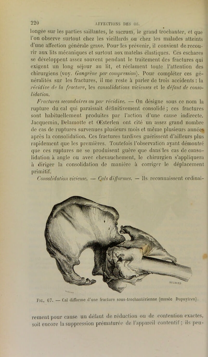 longée sur les parties saillantes, le sacrum, le grand trochanter, et que l’on observe surtout chez les vieillards ou chez les malades atteints d’une affection générale grave. Pour les prévenir, il convient de recou- rir aux lits mécaniques et surtout aux matelas élastiques. Ces eschares se développent assez souvent pendant le traitement des fractures qui exigent un long séjour au lit, et réclament toute l’attention des chirurgiens (voy. Gangrène par compression). Pour compléter ces gé- néralités sur les fractures, il me reste à parler de trois accidents: la récidive de la fracture, les consolidations vicieuses et le défaut de conso- lidation. Fractures secondaires ou par récidive. — On désigne sous ce nom la rupture du cal qui paraissait définitivement consolidé ; ces fractures sont habituellement produites par l’action d’une cause indirecte. Jacquemin, Delamotte et QEsterlen ont cité un assez grand nombre de cas de ruptures survenues plusieurs mois et même plusieurs années après la consolidation. Ces fractures tardives guérissent d’ailleurs plus rapidement que les premières. Toutefois l’observation ayant démontré que ces ruptures ne se produisent guère que dans les cas de conso- lidation à angle ou avec chevauchement, le chirurgien s’appliquera à diriger la consolidation de manière à corriger le déplacement primitif. Consolidation vicieuse. — Qals difformes. — Ils reconnaissent ordinai- Fic. G7. — Cal difforme d’une fracture sous-troclianlérienne (musée Dupuylren). rement pour cause un défaut de réduction ou de contention exactes, soit encore la suppression prématurée de l’appareil contentif; ils peu-