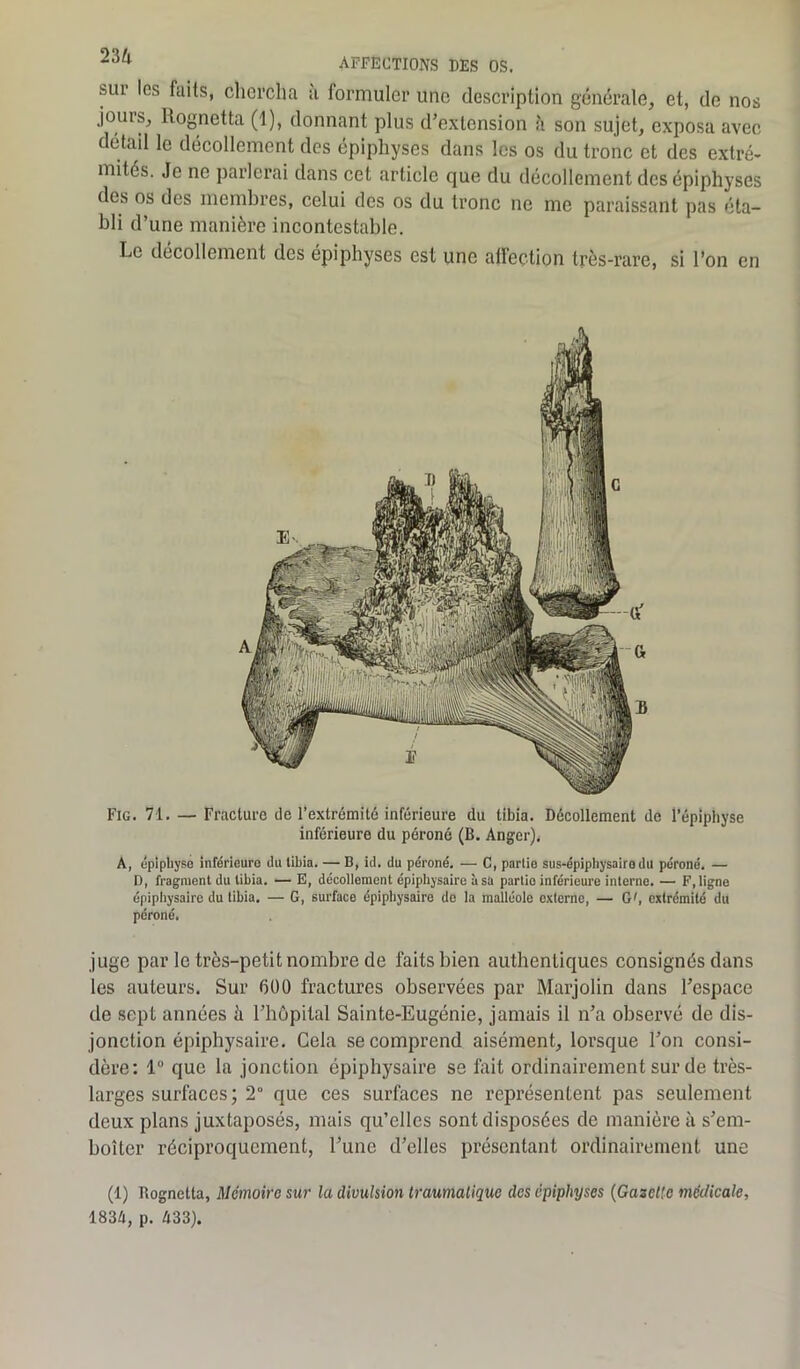 sur les faits, chercha a formuler une description générale, et, de nos jours, Rognetta (1), donnant plus d’extension à son sujet, exposa avec détail le décollement des épiphyses dans les os du tronc et des extré- mités. Je ne parlerai dans cet article que du décollement des épiphyses des os des membres, celui des os du tronc ne me paraissant pas éta- bli d’ une manière incontestable. Le décollement des épiphyses est une affection très-rare, si l’on en Fig. 71. — Fracture de l’extrémité inférieure du tibia. Décollement de l’épiphyse inférieure du péroné (B. Anger). A, épiphyse inférieure du tibia. — B, id. du péroné. — C, partie sus-épiphysairodu péroné. — D, fragment du tibia. — E, décollement épiphysaire à sa partie inférieure interne. — F, ligne épiphysaire du tibia. — G, surface épiphysaire de la mailéole externe, — GG extrémité du péroné. juge par le très-petit nombre de faits bien authentiques consignés dans les auteurs. Sur 600 fractures observées par Marjolin dans l’espace de sept années h l’hôpital Sainte-Eugénie, jamais il n’a observé de dis- jonction épiphysaire. Cela se comprend aisément, lorsque l’on consi- dère: 1° que la jonction épiphysaire se fait ordinairement sur de très- larges surfaces; 2 que ces surfaces ne représentent pas seulement deux plans juxtaposés, mais qu’elles sont disposées de manière à s’em- boîter réciproquement, l’une d’elles présentant ordinairement une (1) Rognetta, Mémoire sur la divulsion traumatique des épiphyses {Gazelle médicale, 1834, p. 433).