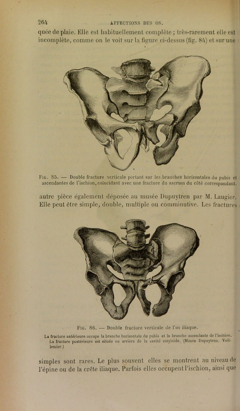 quée de plaie. Elle est habituellement complète ; très-rarement elle est incomplète, comme on le voit sur la figure ci-dessus (fig. 84) et sur une Fig. S5. — Double fracture verticale portant sur les branches horizontales du pubis et ascendantes de l’ischion, coïncidant avec une fracture du sacrum du côté correspondant. autre pièce également déposée au musée Dupuytren par M. Laugier. Elle peut être simple, double, multiple ou comminutive. Les fractures Fig. 86. — Double fracture verticale de l’os iliaque. La fracture antérieure occupe la branche horizonlalo du pubis et la branche ascendante de l'ischion. La fracture postérieure est situéo en arrière do la cavité cotyloide. (Musée Dupuytren. Voil- leniier.) simples sont rares. Le plus souvent elles se montrent au niveau de l’épine ou de la crête iliaque. Parfois elles occupent l’ischion, ainsi que