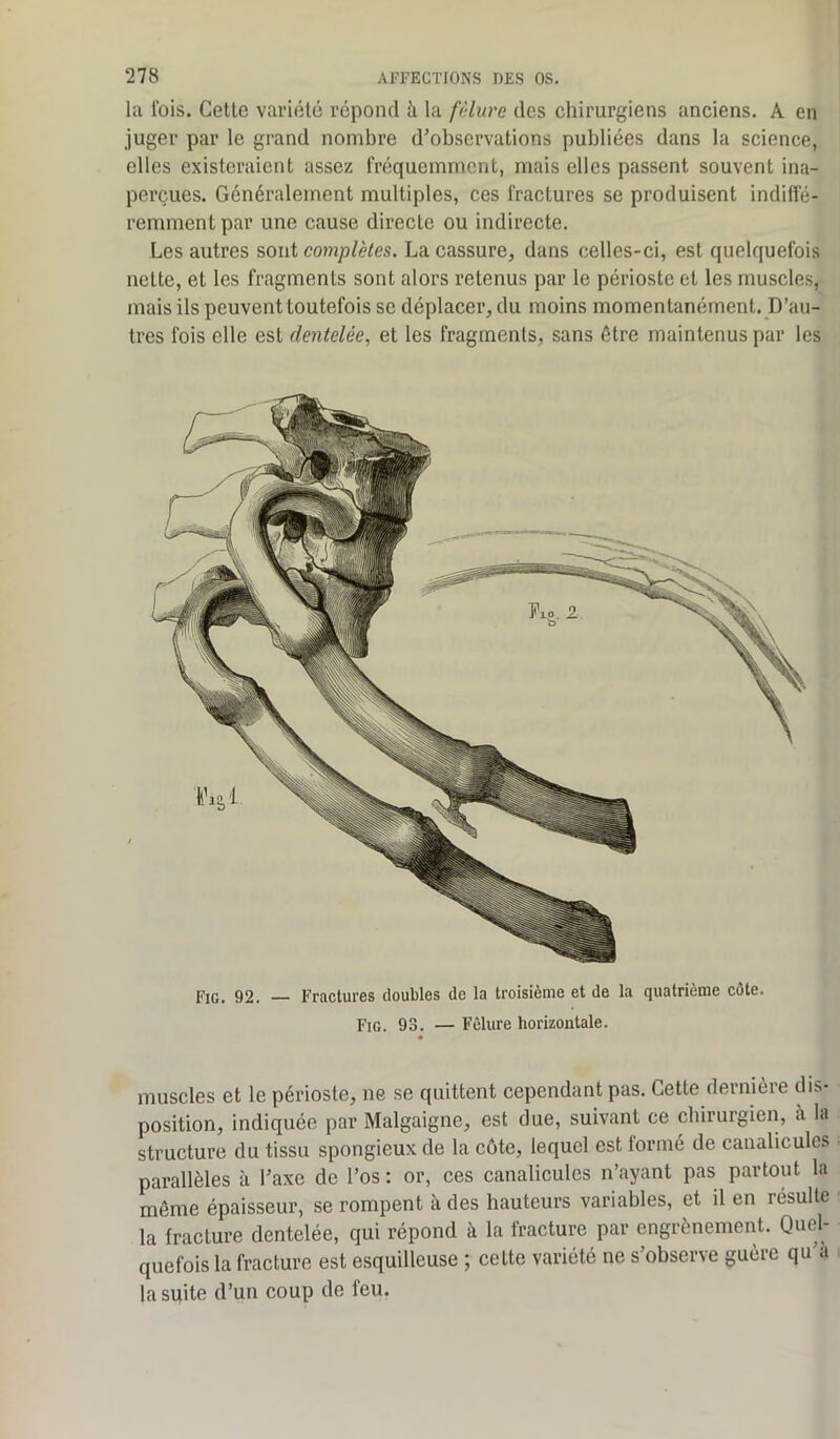 la lois. Cetle variété répond à la fêlure des chirurgiens anciens. A en juger par le grand nombre d'observations publiées dans la science, elles existeraient assez fréquemment, mais elles passent souvent ina- perçues. Généralement multiples, ces fractures se produisent indiffé- remment par une cause directe ou indirecte. Les autres sont complètes. La cassure, dans celles-ci, est quelquefois nette, et les fragments sont alors retenus par le périoste et les muscles, mais ils peuvent toutefois se déplacer, du moins momentanément. D’au- tres fois elle est dentelée, et les fragments, sans être maintenus par les Fig. 92. — Fractures doubles de la troisième et de la quatrième côte. Fig. 98. — Fêlure horizontale. muscles et le périoste, ne se quittent cependant pas. Cette dernière dis- position, indiquée par Malgaigne, est due, suivant ce chirurgien, a la structure du tissu spongieux de la côte, lequel est formé de canalicules parallèles à l'axe de l’os : or, ces canalicules n’ayant pas partout la même épaisseur, se rompent à des hauteurs variables, et il en résulte la fracture dentelée, qui répond à la fracture par engrènement. Quel- quefois la fracture est esquilleuse ; cette variété ne s'observe guère qu'à la suite d’un coup de feu.