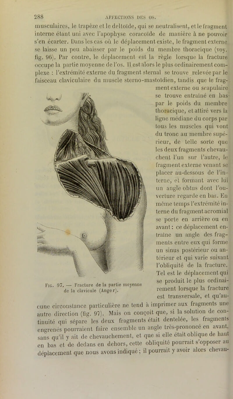 musculaires, le trapèze et le deltoïde, qui se neutralisent, et le fragment interne étant uni avec l’apophyse coracoïde de manière à ne pouvoir s’en écarter. Dans les cas où le déplacement existe, le fragment externe se laisse un peu abaisser par le poids du membre thoracique (voy. fig. 96). Par contre, le déplacement est la règle lorsque la fracture occupe la partie moyenne de l’os. Il est alors le plus ordinairement com- plexe : l’extrémité externe du fragment sternal se trouve relevée par le faisceau claviculaire du muscle sterno-mastoïdien, tandis que le frag- ment externe ou scapulaire se trouve entraîné en bas par le poids du membre thoracique, et attiré vers la ligne médiane du corps par tous les muscles qui vont du tronc au membre supé- rieur, de telle sorte que les deux fragments chevau- chent l’un sur l’autre, le fragment externe venant se placer au-dessous de l’in- terne, et formant avec lui un angle obtus dont l’ou- verture regarde en bas. En même temps l’extrémité in- terne du fragment acromial se porte en arrière ou en avant : ce déplacement en- traîne un angle des frag- ments entre eux qui forme un sinus postérieur ou an- térieur et qui varie suivant l’obliquité de la fracture. Tel est le déplacement qui se produit le plus ordinai- rement lorsque la fracture est transversale, et qu’au- cune circonstance particulière ne tend a imprimer aux fragments une autre direction (fig. 97). Mais on conçoit que, si la solution de con- tinuité qui sépare les deux fragments était dentelée, les fragments engrenés pourraient faire ensemble un angle très-prononcé en avant, sans qu’il y ait de chevauchement, et que si elle était oblique de haut en bas et de dedans en dehors, cette obliquité pourrait s’opposer au déplacement que nous avons indiqué ; il pourrait y avoir alors chevau- Fig. 97. — Fracture de la partie moyenne de la clavicule (Anger).