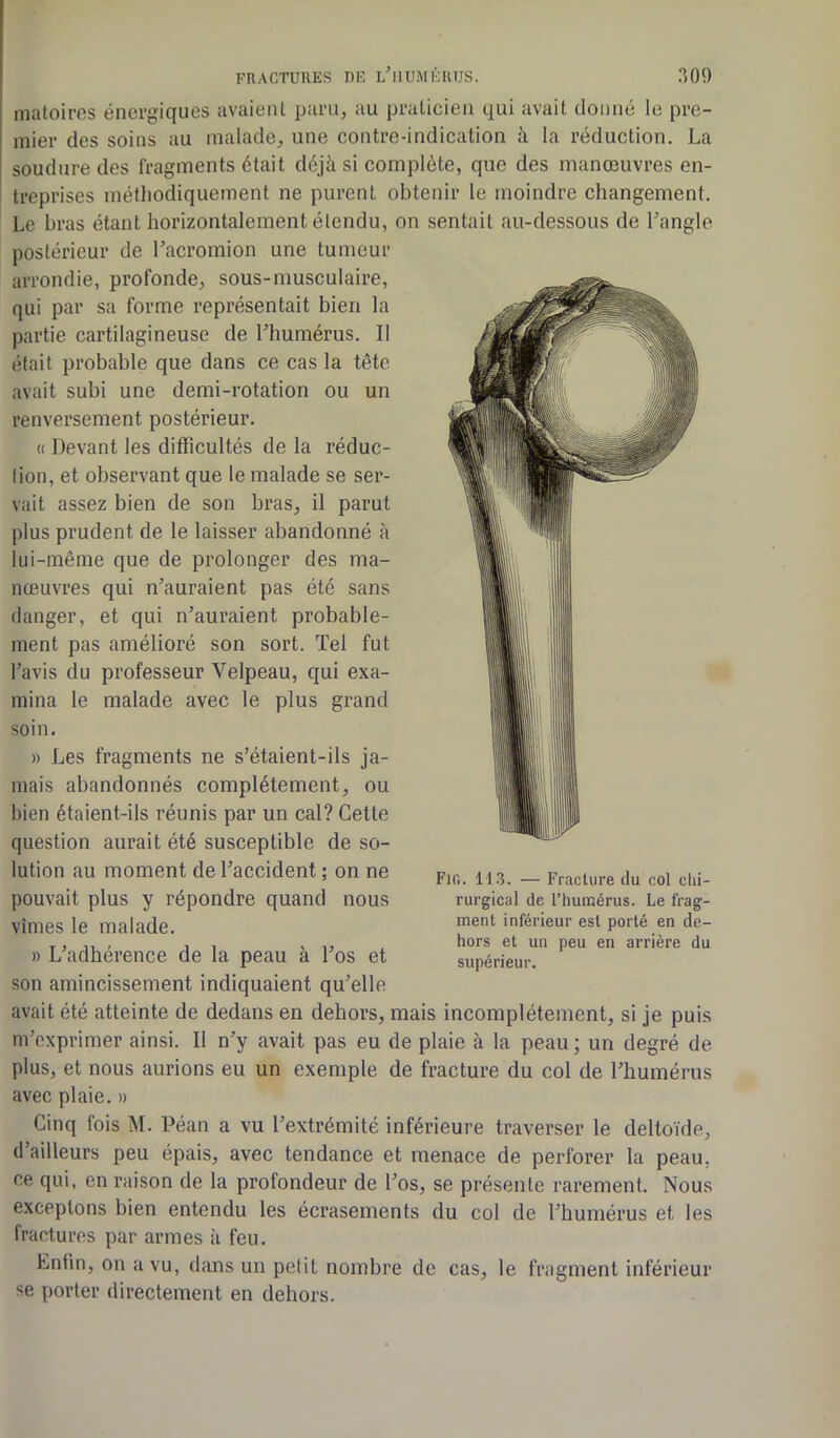 matoires énergiques avaient paru, au praticien qui avait donné le pre- mier des soins au malade, une contre-indication à la réduction. La soudure des fragments était déjà si complète, que des manœuvres en- treprises méthodiquement ne purent obtenir le moindre changement. Le bras étant horizontalement étendu, on sentait au-dessous de l'angle postérieur de l’acromion une tumeur arrondie, profonde, sous-musculaire, qui par sa forme représentait bien la partie cartilagineuse de l'humérus. Il était probable que dans ce cas la tête avait subi une demi-rotation ou un renversement postérieur. « Devant les difficultés de la réduc- tion, et observant que le malade se ser- vait assez bien de son bras, il parut plus prudent de le laisser abandonné à lui-même que de prolonger des ma- nœuvres qui n'auraient pas été sans danger, et qui n'auraient probable- ment pas amélioré son sort. Tel fut l’avis du professeur Velpeau, qui exa- mina le malade avec le plus grand soin. » Les fragments ne s’étaient-ils ja- mais abandonnés complètement, ou bien étaient-ils réunis par un cal? Cette question aurait été susceptible de so- lution au moment de l'accident ; on ne pouvait plus y répondre quand nous vîmes le malade. » L'adhérence de la peau à l'os et son amincissement indiquaient qu'elle avait été atteinte de dedans en dehors, mais incomplètement, si je puis m’exprimer ainsi. Il n'y avait pas eu de plaie à la peau; un degré de plus, et nous aurions eu un exemple de fracture du col de l’humérus avec plaie. » Cinq fois M. Péan a vu l’extrémité inférieure traverser le deltoïde, d’ailleurs peu épais, avec tendance et menace de perforer la peau, ce qui, en raison de la profondeur de l’os, se présente rarement. Nous exceptons bien entendu les écrasements du col de l'humérus et les fractures par armes à feu. hnfin, on a vu, dans un petit nombre de cas, le fragment inférieur se porter directement en dehors. Fig. 113. — Fracture du col chi- rurgical de l’humérus. Le frag- ment. inférieur est porté en de- hors et un peu en arrière du supérieur.
