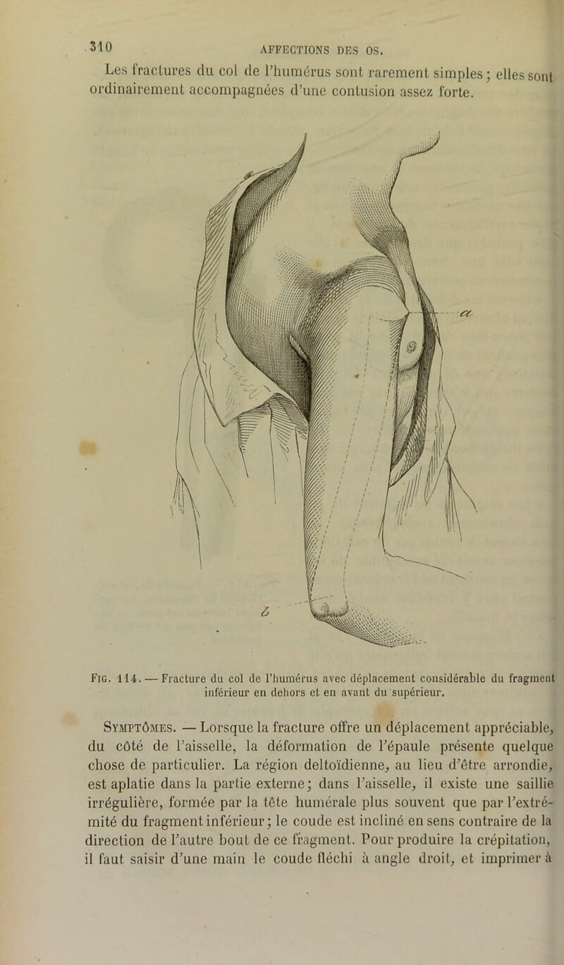 Les fractures du col de l’humérus sont rarement simples; elles sont ordinairement accompagnées d’une contusion assez forte. Fig. 114. — Fracture du col de l’humérus avec déplacement considérable du fragment inférieur en dehors et en avant du supérieur. Symptômes. — Lorsque la fracture offre un déplacement appréciable, du côté de l’aisselle, la déformation de l’épaule présente quelque chose de particulier. La région deltoïdienne, au lieu d’être arrondie, est aplatie dans la partie externe; dans l’aisselle, il existe une saillie irrégulière, formée par la tête humérale plus souvent que par l’extré- mité du fragment inférieur ; le coude est incliné en sens contraire de la direction de l’autre bout de ce fragment. Pour produire la crépitation, il faut saisir d’une main le coude fléchi à angle droit, et imprimer à