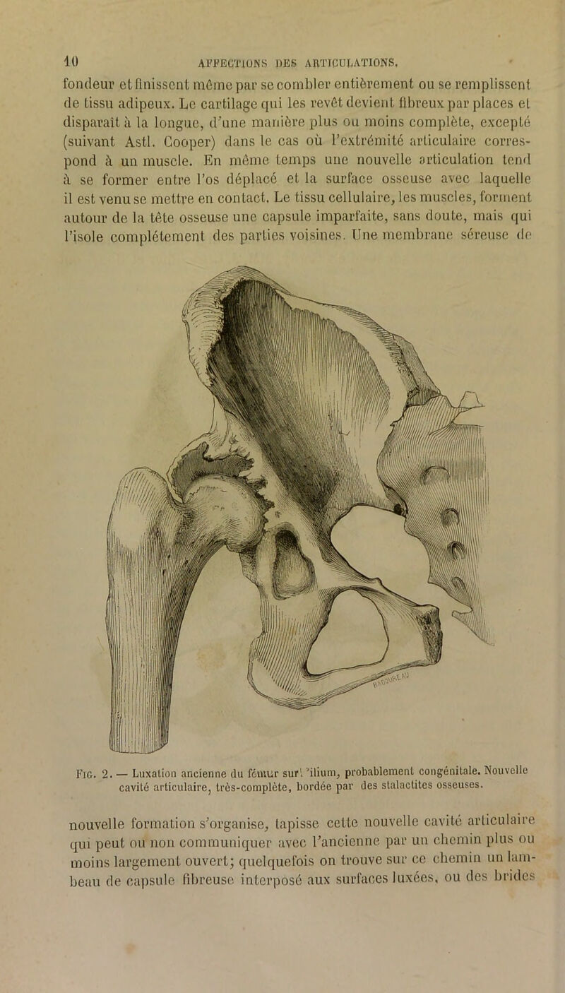 fondeur et finissent mûinc par se combler entièrement ou se remplissent de tissu adipeux. Le cartilage qui les revêt devient fibreux par places el disparaît à la longue, d’une manière plus ou moins complète, exeeplé (suivant Asti. Gooper) dans le cas où l’extrémité articulaire corres- pond à un muscle. En môme temps une nouvelle articulation tend ù. se former entre l’os déplacé et la surface osseuse avec laquelle il est venu se mettre en contact. Le tissu cellulaire, les muscles, forment autour de la tête osseuse une capsule imparfaite, sans doute, mais qui l’isole complètement des parties voi.sines. Une membrane séreuse do Fig. 2. — Luxation ancienne du fémur suri ''ilium, probablement congénitale. Nouvelle cavité articulaire, très-complète, bordée par des stalactites osseuses. nouvelle formation s’organise, tapisse cette nouvelle cavité articulaire qui peut ou non communiquer avec l’ancienne par un cbemin plus ou moins largement ouvert; quelquefois on trouve sur ce cbemin un lam- beau de capsule fibreuse interposé aux surfaces luxées, ou des brides