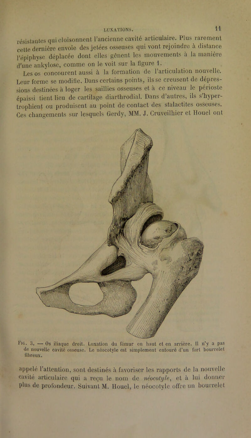 résistantes qui cloisonnent l’ancienne cavité articulaire. Plus rarement cette dernière envoie des jetées osseuses qui vont rejoindre à distance l’épiphyse déplacée dont' elles gênent les mouvements à la manière d’une ankylosc, comme on le voit sur la figure 1. Les os concourent aussi à la formation de l’articulation nouvelle. Leur forme se modifie. Dans certains points, ils se creusent de dépres- sions destinées à loger les saillies osseuses et à ce niveau le périoste épaissi tient lieu de cartilage diarthrodial. Dans d’autres, ils s’hyper- tropliient ou produisent au point de contact des stalaiitites osseuses. Ces changements sur lesquels Gerdy, MM. J. Cruveilhier et Houel ont Fig. 3. — Os iliaque droit. Luxation du fémur en haut et en arrière. Il n’y a pas de nouvelle cavité osseuse. Le néocotyle est simplement entouré d’un fort bourrelet fibreux. appelé l’attention, sont destinés à favoriser les rapports de la nouvelle cavité articulaire qui a reçu le nom de néocotijle, et ii lui donner plus de profondeur. Suivant M. Houel, le néocotyle olïVe un bourrelet