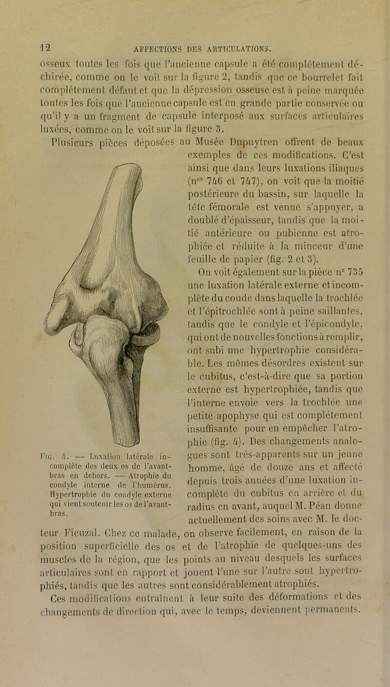 osseux toutes les fois que r.'uicienne capsule a été complètement dé- chirée, comme on le voit sur la figure 2, tandis que ce bourrelet fait complètement défaut et que la dépression osseuse est à peine marquée toutes les fois que l’ancienne capsule est en grande partie conservée ou qu’il y a un fragment de capsule interposé aux surfaces articulaires luxées, comme on le voit sur la figure 3. Plusieurs pièces déposées au Musée Dupuytren offrent de beaux exemples de ces modifications. C’est ainsi que dans leurs luxations iliaques (n®* 7Zi6 et Ihl), on voit que la moitié postérieure du bassin, sur laquelle la tête fémorale est venue s’appuyer, a doublé d’épaisseur, tandis'que la moi- tié antérieure ou pubienne est atro- phiée et réduite à la minceur d’une feuille de papier (fig. 2 et 3). On voit également sur la pièce n“ 735 une luxation latérale externe et incom- plète du coude dans laquelle la trochlée et l’épitrochlée sont à peine saillantes, tandis que le condyle et l’épicondyle, qui ont de nouvelles fonctions à remplir, ont subi une hypertrophie considéra- ble. Les mômes désordres existent sur le cubitus, c’est-à-dire que sa portion externe est hypertrophiée, tandis que l’interne envoie vers la trochlée une petite apophyse qui est complètement insuffisante pour en empêcher l’atro- phie (fig. U). Des changements analo- gues sont très-apparents sur un jeune homme, âgé de douze ans et affecté depuis trois années d’une luxation in- complète du cubitus en arrière et du radius en avant, auquel M. Péan donne actuellement des soins avec M. le doc- teur Fieuzal. Chez ce malade, on observe facilement, en raison de la position superficielle des os et de l’atrophie de quelques-uns des muscles de la région, que les points au niveau desquels les surfaces articulaires sont en rapport et jouent l’une sur l’autre sont hypertro- phiés, tandis que les autres sont considérablement atrophiés. Ces modifications entraînent à leur suite des déformations et des changements de direction qui, avec le temps, deviennent jicrmanenls. Fu; . — Lnxalion latérale in- complète des deux os de l’avant- bras en dehors. — Atrophie du condyle interne de l’humérus. Hypertrophie du condyle externe qui vient soutenir les os de l’avant- bras.