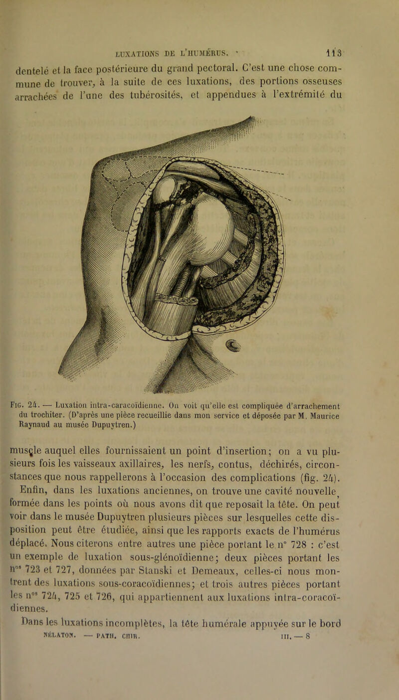 Fig. 24. — Luxation intra-caracoïdieiine. üa voit qu’elle est compliquée d’arrachement du trochiter. (D’après une pièce recueillie dans mon service et déposée par M. Maurice Raynaud au musée Dupuytren.) musçle auquel elles fournissaient un point d’insertion; on a vu plu- sieurs fois les vaisseaux axillaires, les nerfs, contus, déchirés, circon- stances que nous rappellerons à l’occasion des complications (fig. 2U). Enfin, dans les luxations anciennes, on trouve une cavité nouvelle^ formée dans les points où nous avons dit que reposait la tôte. On peut voir dans le musée Dupuytren plusieurs pièces sur lesquelles cette dis- position peut être étudiée, ainsi que les rapports exacts de l’humérus déplacé. Nous citerons entre autres une pièce portant le n“ 728 : c’est un exemple de luxation sous-glénoïdienne; deux pièces portant les H”‘ 723 et 727, données par Stanski et Demeaux, celles-ci nous mon- trent des luxations sous-coracoïdiennes; et trois autres pièces portant les n°’ 72/i, 725 et 726, qui appartiennent aux luxations inlra-coracoï- (liennes. Dans les luxations incomplètes, la tôte humérale appuyée sur le bord NÉI.ATON. — PATH. CniK. III. — 8 LUXATIONS DE l’hUMÉRUS. ' 113 dentelé et la face postérieure du grand pectoral. C’est une chose com- mune de trouver, à la suite de ces luxations, des portions osseuses arrachées de l’une des tubérosités, et appendues à l’extrémité du