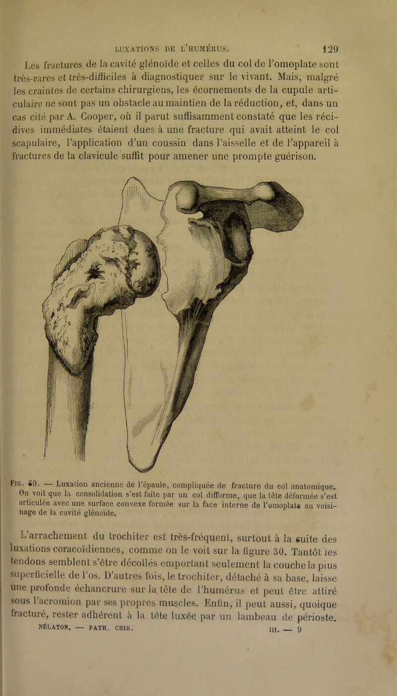 Les fraclures de la cavité glénoïde et celles du col de Tomoplate sont très-rares et très-diliiciles à diagnostiquer sur le vivant. Mais, malgré les craintes de certains chirurgiens, les écornements de la cupule arti- culaire ne sont pas un obstacle au maintien de la réduction, et, dans un cas cité par A. Gooper, où il parut suffisamment constaté que les réci- dives immédiates étaient dues à une fracture qui avait atteint le col scapulaire, l’application d’un coussin dans l’aisselle et de l’appareil à fractures de la clavicule suffit pour amener une prompte guérison. I I Fig. SO. — Luxation ancienne de l’épaule, compliquée de fracture du col anatomique. On voit que la consolidation s’est faite par un col difforme, que la tête déformée s’est articulée avec une surface convexe formée sur la face interne de l’omoplate au voisi- nage de la cavité glénoïde. i ! L’arrachement du trochiter est très-fréquent, surtout à la suite des luxations coracoïdiennes, comme on le voit sur la figure 30. Tantôt les tendons semblent s’ôtre décollés emportant seulement la couche la pius superficielle de 1 os. D’autres fois, le trochiter, détaché à sa base, laisse une profonde échancrure sur la lête de l’humérus et peut être attiré sous l’acromion par ses propres muscles. Enfin, il peut aussi, quoique fracturé, rester adhérent à la tête luxée par un lambeau de périoste. îiÉLATON. — PATH. CHIR. Hj. g