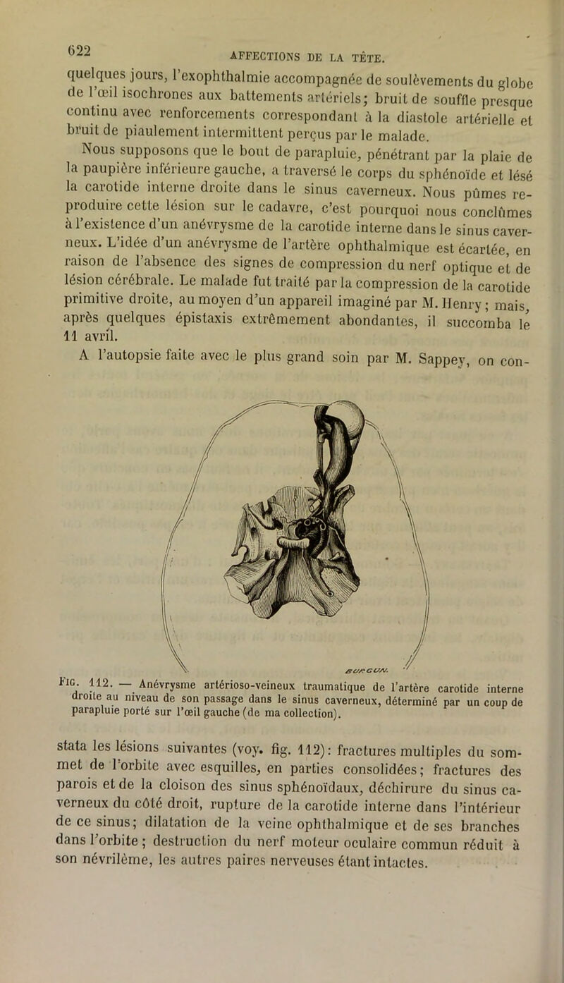 quelques jours, l’exophthalmie accompagnée de soulèvements du globe de 1 œil isochrones aux battements artériels; bruit de souffle presque continu avec renforcements correspondant à la diastole artérielle et bruit de piaulement intermittent perçus par le malade. Nous supposons que le bout de parapluie, pénétrant par la plaie de la paupière inférieure gauche, a traversé le corps du sphénoïde et lésé la carotide interne droite dans le sinus caverneux. Nous pûmes re- produire cette lésion sur le cadavre, c’est pourquoi nous conclûmes à l’existence d’un anévrysme de la carotide interne dans le sinus caver- neux. L’idée d’un anévrysme de l’artère ophthalmique est écartée, en raison de l’absence des signes de compression du nerf optique et de lésion cérébrale. Le malade fut traité par la compression de la carotide primitive droite, au moyen d’un appareil imaginé par M. Henry ; mais après quelques épistaxis extrêmement abondantes, il succomba le 11 avril. A l’autopsie faite avec le plus grand soin par M. Sappey, on con- Fig. 112. — Anévrysme artérioso-veineux traumatique de l’artère carotide interne droite au niveau de son passage dans le sinus caverneux, déterminé par un coup de parapluie porté sur l’œil gauche (de ma collection). stata les lésions suivantes (voy. fig. 112): fractures multiples du som- met de l orbite avec esquilles, en parties consolidées; fractures des parois et de la cloison des sinus sphénoïdaux, déchirure du sinus ca- verneux du côté droit, rupture de la carotide interne dans l’intérieur de ce sinus; dilatation de la veine ophthalmique et de ses branches dans l’orbite; destruction du nerf moteur oculaire commun réduit à son névriléme, les autres paires nerveuses étant intactes.