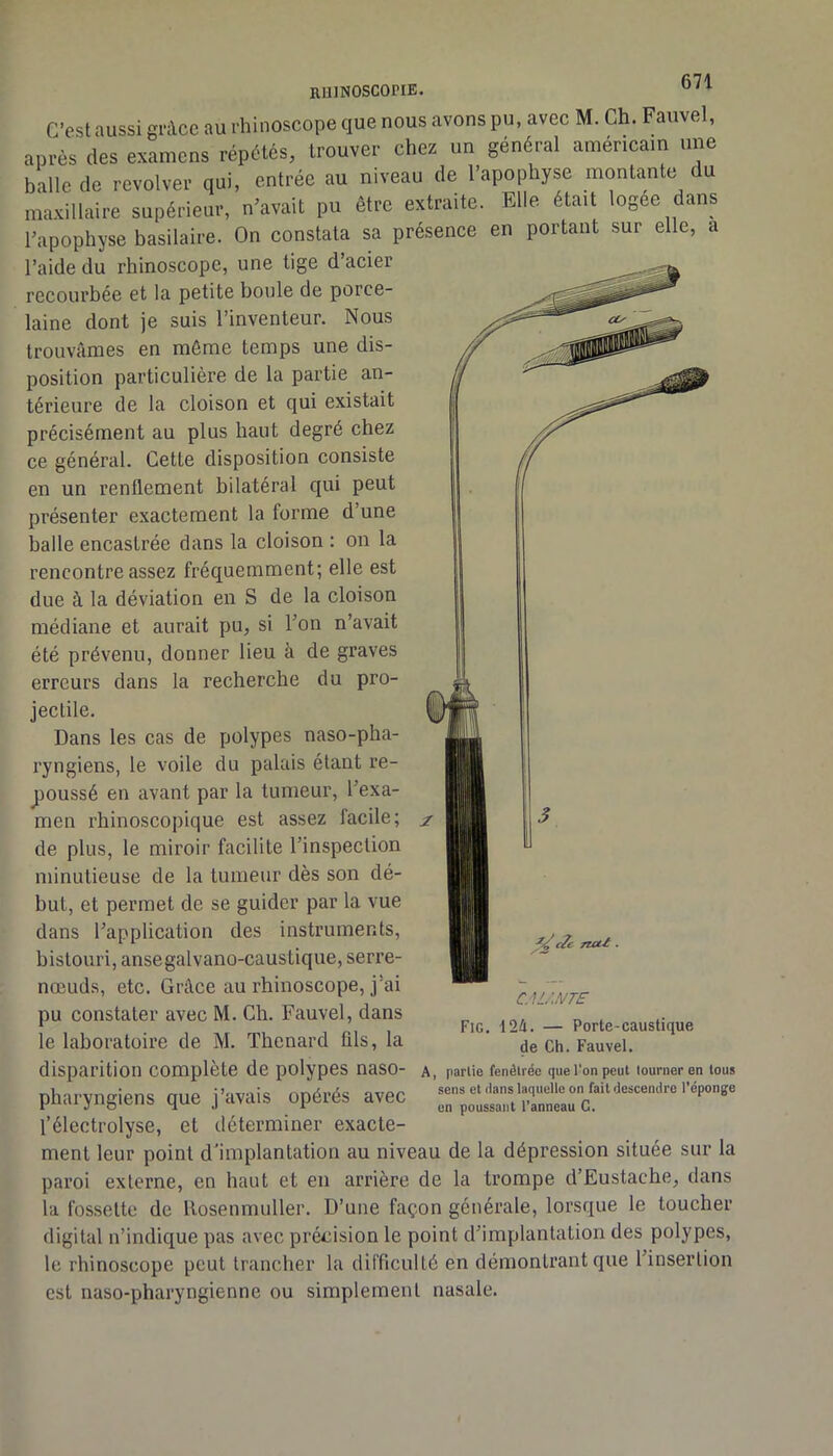 C'estaussi gricc au i hinoscope que nous avons pu. avec M. Ch. Fauvel, apvès (les examens répétés, trouver chez un général américam une balle de revolver qui, entrée au niveau de l'apophyse montante du ma.xillaire supérieur, n’avait pu être extraite. Elle était logée dans l’apophyse basilaire. On constata sa présence en portant sur elle, a l’aide du rhinoscope, une tige d’acier recourbée et la petite boule de porce- laine dont je suis l’inventeur. Nous trouvâmes en môme temps une dis- position particulière de la partie an- térieure de la cloison et qui existait précisément au plus haut degré chez ce général. Cette disposition consiste en un renflement bilatéral qui peut présenter exactement la forme d’une balle encastrée dans la cloison : on la rencontre assez fréquemment; elle est due à la déviation en S de la cloison médiane et aurait pu, si Ton n’avait été prévenu, donner lieu à de graves erreurs dans la recherche du pro- jectile. Dans les cas de polypes naso-pha- ryngiens, le voile du palais étant re- poussé en avant par la tumeur, l’exa- men rhinoscopique est assez facile; de plus, le miroir facilite l’inspection minutieuse de la tumeur dès son dé- but, et permet de se guider par la vue dans l’application des instruments, bistouri, ansegalvano-caustique, serre- nœuds, etc. Grâce au rhinoscope, j’ai pu constater avec M. Ch. Fauvel, dans le laboratoire de M. Thénard fds, la disparition complète de polypes naso- pharyngiens que j’avais opérés avec l’électrolyse, et déterminer exacte- ment leur point d'implantation au niveau de la dépression située sur la paroi externe, en haut et en arrière de la trompe d’Eustache, dans la fossette de Rosenmuller. D’une façon générale, lorsque le toucher digital n’indique pas avec précision le point d’implantation des polypes, le rhinoscope peut trancher la difficulté en démontrant que l’insertion est naso-pharyngienne ou simplement nasale. Je nut. CM/MTE Fig. 124. — Porte-caustique de Ch. Fauvel. A, partie fenêlrée que l'on peut tourner en tous sens et dans laquelle on fait descendre l'éponge en poussant l’anneau C.