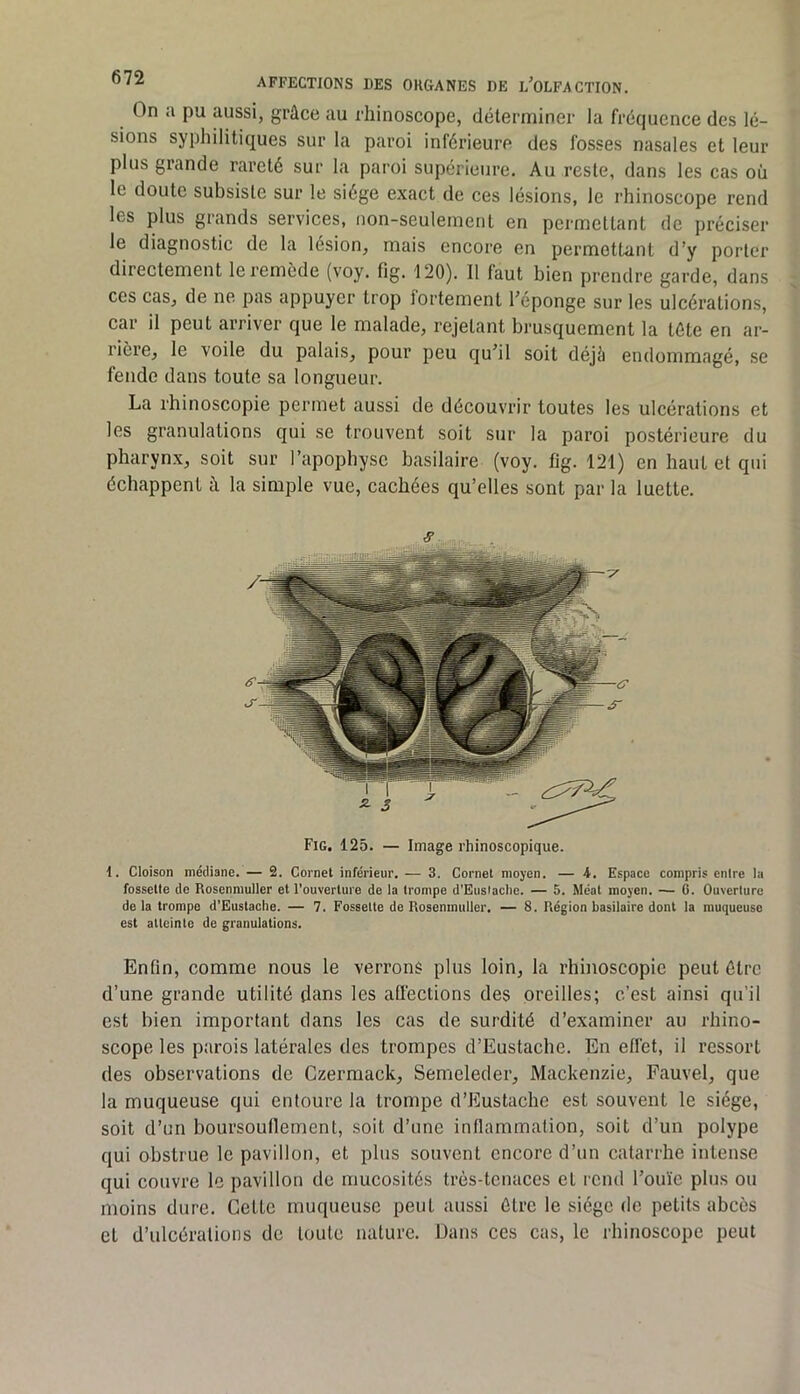 On a pu aussi, grâce au rhinoscope, déterminer la fréquence des lé- sions syphilitiques sur la paroi inférieure des fosses nasales et leur plus grande rareté sur la paroi supérieure. Au reste, dans les cas où le doute subsiste sur le siège exact de ces lésions, le rhinoscope rend les plus grands services, non-seulement en permettant de préciser le diagnostic de la lésion, mais encore en permettant d’y porter directement le remède (voy. fig. 120). Il faut bien prendre garde, dans ces cas, de ne. pas appuyer trop fortement l’éponge sur les ulcérations, car il peut arriver que le malade, rejetant brusquement la tête en ar- rière, le voile du palais, pour peu qu’il soit déjè endommagé, se fende dans toute sa longueur. La rhinoscopie permet aussi de découvrir toutes les ulcérations et les granulations qui se trouvent soit sur la paroi postérieure du pharynx, soit sur l’apophyse basilaire (voy. fig. 121) en haut et qui échappent à la simple vue, cachées qu’elles sont par la luette. Fig. 125. — Image rhinoscopique. I. Cloison médiane. — 2. Cornet inférieur. — 3. Cornet moyen. — 4. Espace compris entre la fossette de Rosenmuller et l’ouverture de la trompe d’EusIache. — 5. Méat moyen. — 0. Ouverture delà trompe d’Eustaclie. — 7. Fossette de Roaenmuller. — 8. Région basilaire dont la muqueuse est atteinte de granulations. Enfin, comme nous le verrons plus loin, la rhinoscopie peut être d’une grande utilité dans les affections des oreilles; c’est ainsi qu’il est bien important dans les cas de surdité d’examiner au rhino- scope les parois latérales des trompes d’Eustache. En effet, il ressort des observations de Czermack, Semeleder, Mackenzie, Fauvel, que la muqueuse qui entoure la trompe d’Eustache est souvent le siège, soit d’un boursouflement, soit d’une inflammation, soit d’un polype qui obstrue le pavillon, et plus souvent encore d’un catarrhe intense qui couvre le pavillon de mucosités très-tenaces et rend l’ouïe plus ou moins dure. Cette muqueuse peut aussi être le siège de petits abcès et d’ulcéralions de toute nature. Dans ces cas, le rhinoscope peut