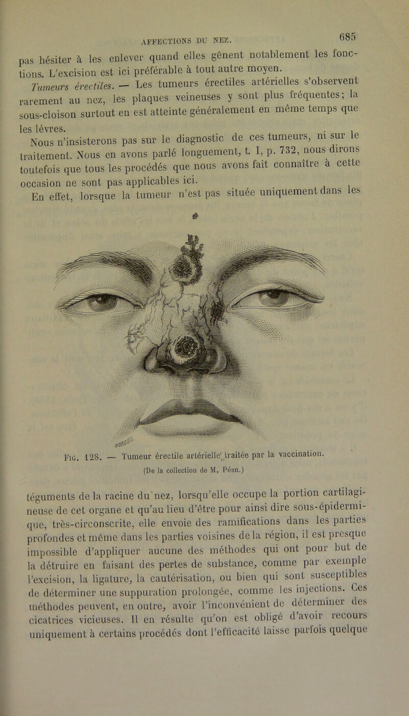 AFFECTIONS DU NEZ. pas hésiter à les enlever quand elles gênent notablement les fonc- tions. L’excision est ici préférable à tout autre moyen. Tumeurs érectiles. - Les tumeurs érectiles artérielles s’observent rarement au nez, les plaques veineuses y sont plus fréquentes ; la sous-cloison surtout en est atteinte généralement en même temps que les lèvres Nous n’insisterons pas sur le diagnostic de ces tumeurs, ni sur le traitement. Nous en avons parlé longuement, t. I, p. 732, nous dirons toutefois que tous les procédés que nous avons fait connaître à cette occasion ne sont pas applicables ici. En elfet, lorsque la tumeur n’est pas située uniquement dans es FiG. 128. — Tumeur érectile artérielle'^ traitée par la vaccination. (De la collection de M. Péan.) téguments delà racine du'nez, lorsqu’elle occupe la portion cartilagi- neuse de cet organe et qu’au lieu d’être pour ainsi dire sous-épidermi- que, très-circonscrite, elle envoie des ramifications dans les parties profondes et môme dans les parties voisines delà région, il est presque impossible d’appliquer aucune des méthodes qui ont pour but de la détruire en faisant des pertes de substance, comme par exemple l’excision, la ligature, la cautérisation, ou bien qui sont suscepliWes de déterminer une suppuration prolongée, comme les injections. Ces méthodes peuvent, en outre, avoir rinconvénieiit de détermiiiei des cicatrices vicieuses. 11 en résulte qu’on est obligé d avoir recours uniquement h certains ])i'Océdés dont l’eflicacité laisse parlois quelque