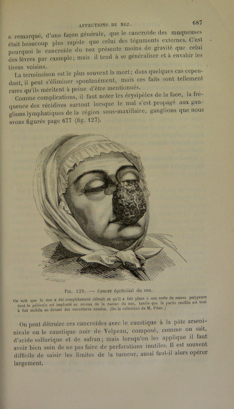AFFECTIONS DU NEZ. a remarqué, d'une façon sénérale, que le oancroïde des muqueuses était beaucoup plus rapide que celui des téguments ettternes. O est Dourquoi le oancroïde du nés présente moins de g.avite que celui ‘les lèvres par exemple; mais il tend à se généraliser et à envahir les tissus voisins. La terminaison est le plus souvent la mort ; dans quelques cas cepen- dant, il peut s’éliminer spontanément, mais ces faits sont tellement rares qu’ils méritent'à peine d’être mentionnés. , . Comme complications, il faut noter les érysipèles de la tace, la Ire- nuence des récidives surtout lorsque le mal s’est propagé aux gan- glions lymphatiques de la région sous-maxillaire, ganglions que nous avons figurés page 677 (fig. 127). Fig. .129. —• Cancer épithélial du nez. On vüil mie le nez a clé complélement détruit et qu’il a fait place à une sorte de masse poljpeuso dont le pédicu'.c est implanté au niveau de la racine du nez, tandis que la partie rentlee est ou à fait mobile au devant des ouvertures nasales. (Delà collection do M. Péan.) On peut détruire ces cancroïdes avec le caustique à la ptUe arseni- nicale ou le caustique noir de Velpeau, composé, comme on sait, d’acide sulfurique et de safran; mais lorsqu’on les applique il faut avoir bien soin de ne pas faire de perforations inutiles. 11 est souvent difficile tic saisir les limites de la tumeur, aussi laut-il alors opéiei largement.