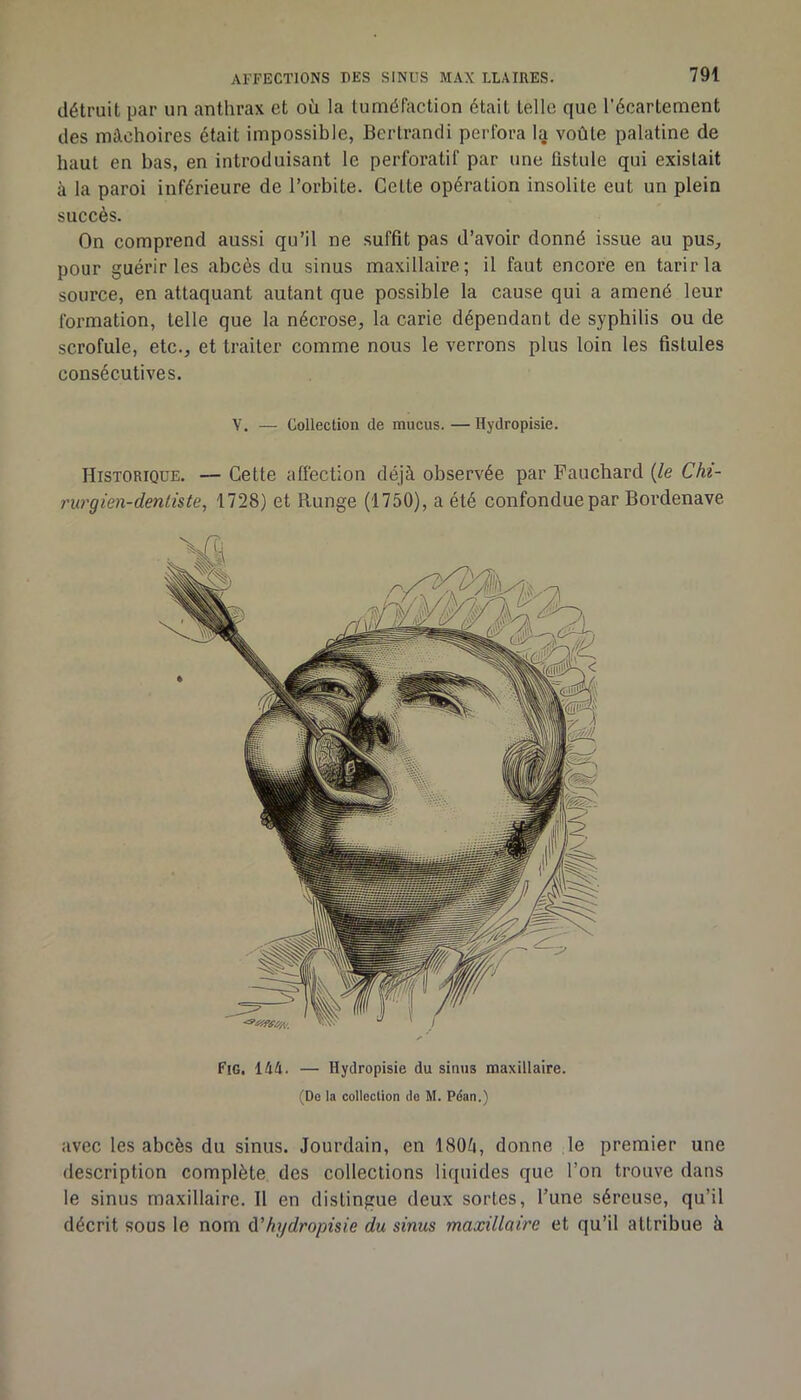 détruit par un anthrax et oîi la tuméfaction était telle que l’écartement des mâchoires était impossible, Bertrandi perfora I5 voûte palatine de haut en bas, en introduisant le perforatif par une fistule qui existait à la paroi inférieure de l’orbite. Celte opération insolite eut un plein succès. On comprend aussi qu’il ne suffit pas d’avoir donné issue au pus, pour guérir les abcès du sinus maxillaire; il faut encore en tarir la source, en attaquant autant que possible la cause qui a amené leur formation, telle que la nécrose, la carie dépendant de syphilis ou de scrofule, etc., et traiter comme nous le verrons plus loin les fistules consécutives. V. — Collection de mucus. — Hydropisie. Historique. — Cette affection déjà observée par Fauchard {le Chi- nirgien-dentiste, 1728) et Runge (1750), a été confondue par Bordenave Fig. 144. — Hydropisie du sinus maxillaire. (Do la collection de M. Péan.) avec les abcès du sinus. Jourdain, en 180à, donne ,1e premier une description complète des collections liquides que l’on trouve dans le sinus maxillaire. Il en distingue deux sortes, l’une séreuse, qu’il décrit sous le nom ù.'hydropisie du sinus maxillaire et qu’il attribue à