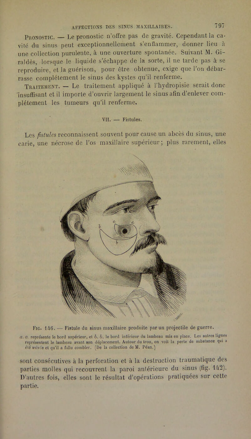 Pronostic. — Le pronostic n’offre pas de gravité. Cependant la ca- vité dn sinus peut exceptionnellement s’enflammer, donner lieu fi une collection purulente, à une ouverture spontanée. Suivant M. Gi- raldès, lorsque le liquide s’échappe de la sorte, il ne tarde pas à se reproduire, et la guérison, pour être obtenue, exige que l’on débar- rasse complètement le sinus des kystes qu’il renferme. Traitement. — Le traitement appliqué à l’hyclropisie serait donc Insuffisant et il importe d’ouvrir largement le sinus afin d’enlever com- plètement les tumeurs qu’il renferme. VII. — Fistules. Les fistules reconnaissent souvent pour cause un abcès du sinus, une carie, une nécrose de l’os maxillaire supérieur; plus rarement, elles Fig. 146. — Fistule du sinus maxillaire produite par un projectile de guerre. n, fl. représente le bord supérieur, et b. b. le bord inférieur du lambeau mis en place. Les autres lignes représentent le lambeau avant son déplacement. Autour du trou, on voit la perte de substance qui a été avivée et qu'il a fallu combler. (De la collection de M. Péan.) sont consécutives à la perforation et à la deslruction traumatique des parties molles qui recouvrent la paroi antérieure du sinus (fig. \k2). D’autres fois, elles sont le résultat d’opérations pratiquées sur cette partie.