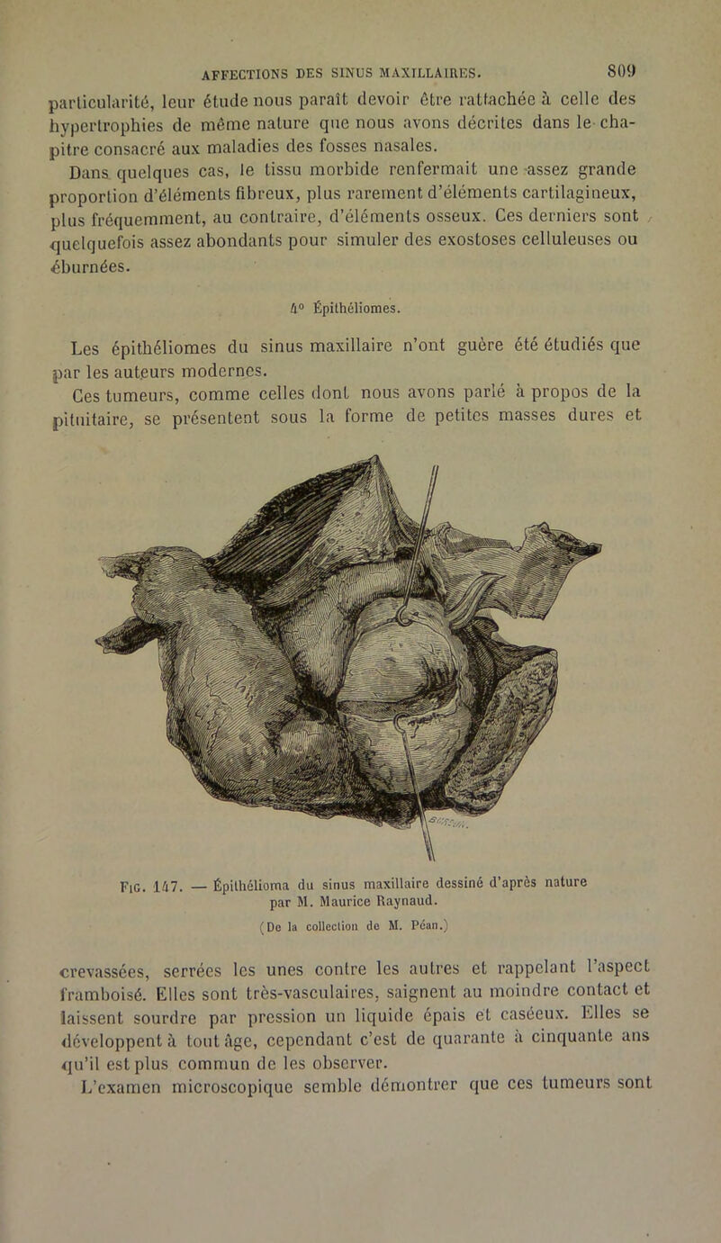 particularité, leur étude nous paraît devoir être rattachée à celle des hypertrophies de même nature que nous avons décrites dans le cha- pitre consacré aux maladies des fosses nasales. Dans quelques cas, le tissu morbide renfermait une assez grande proportion d’éléments fibreux, plus rarement d’éléments cartilagineux, plus fréquemment, au contraire, d’éléments osseux. Ces derniers sont , quelquefois assez abondants pour simuler des exostoses celluleuses ou éburnées. 4° Épithéliomes. Les épithéliomes du sinus maxillaire n’ont guère été étudiés que par les auteurs modernes. Ces tumeurs, comme celles dont nous avons parlé à propos de la pituitaire, se présentent sous la forme de petites masses dures et Fic. 147. — Épilhélioma du sinus maxillaire dessiné d’après nature par M. Maurice Raynaud. (De la collection de M. Pcan.) crevassées, serrées les unes contre les autres et rappelant 1 aspect framboisé. Elles sont très-vasculaires, saignent au moindre contact et laissent sourdre par pression un liquide épais et caséeux. Elles se développent à tout âge, cependant c’est de quarante a cinquante ans qu’il est plus commun de les observer. If examen microscopique semble démontrer que ces tumeurs sont