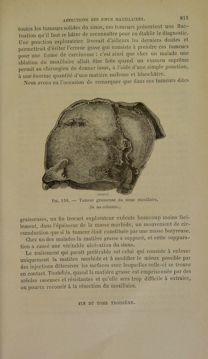 toutes les tumeurs solides du sinus, ces tumeurs présentent une fluc- tuation qu’il faut se hâter de reconnaître pour en établir le diagnostic. Une ponction exploratrice lèverait d’ailleurs les derniers doutes et permettrait d’éviter l’erreur grave qui consiste i\ prendre ces tumeurs pour une forme de carcinome : c’est ainsi que chez un malade une ablation du maxillaire allait être faite quand un examen suprême permit au chirurgien de donner issue, à l’aide d une simple ponction, à une énorme quantité d’une matière suifeuse et blanchâtre. Nous avons eu l’occasion de remarquer que dans ces tumeurs dites Fig. lis. — Tumeur graisseuse du sinus maxillaire. (De ma collection.) graisseuses, un fin trocart explorateur exécute beaucoup moins faci- lement, dans l’épaisseur de la masse morbide, un mouvement de cir- cumduction que si la tumeur était constituée par une masse butyreuse. Chez un des malades la matière grasse a suppuré, et cette suppura- tion a causé une véritable ulcération du sinus. Le traitement qui paraît préférable est celui qui consiste à enlever uniquement la matière morbide et à modifier le mieux possible par des injections détersives les surfaces avec lesquelles celle-ci se trouve en contact. Toutefois, quand la matière grasse est emprisonnée par des aréoles osseuses et résistantes et qu’elle sera trop difficile â extraire, on pourra recourir â la résection du maxillaire. FIN DU TOME TROISIÈME.