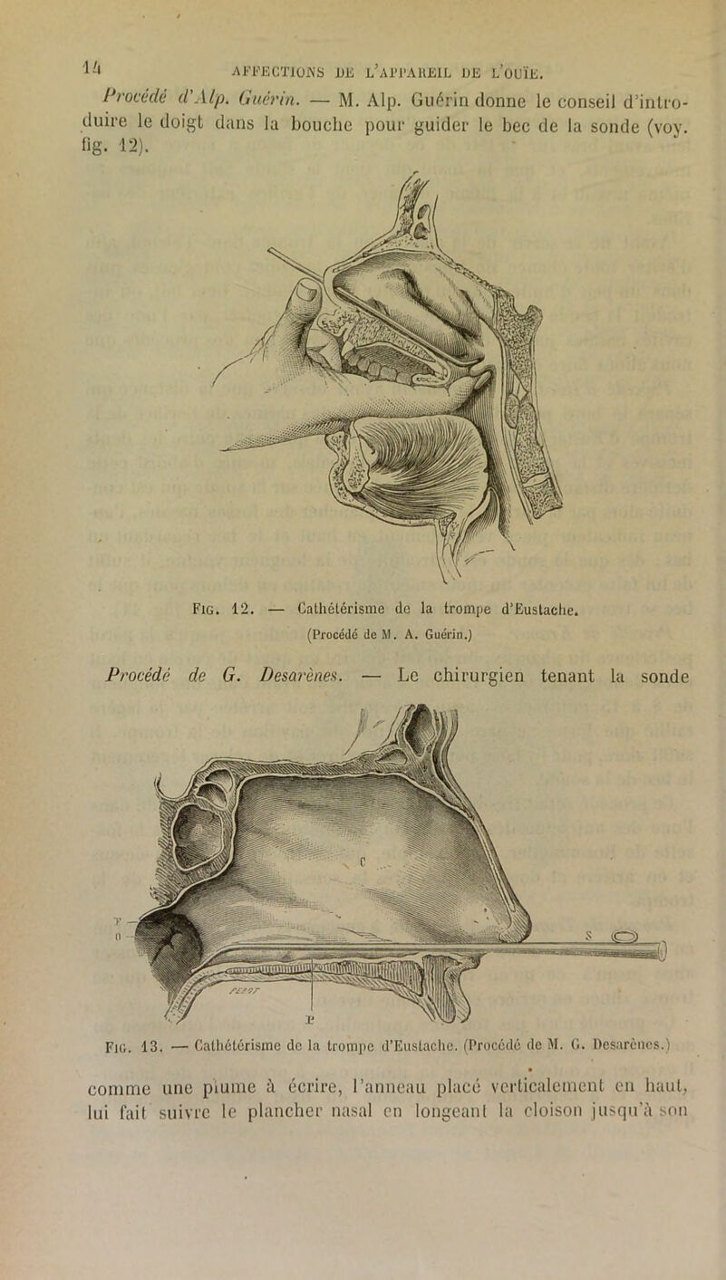 'l'i Al■'i■’ECT10^’S DE l'aI’I'AUEIL DE L’oUÏE. I*rovedé d'Alp. Guérin. — M. Alp. Guérin donne le conseil d’intro- duire le doigt dans la bouche pour guider le bec de la sonde (voy. fig. 12). — Cathétérisme do la trompe d’Eustaclie. (Procédé de M. A. Guérin.) Procédé de G. Desarènea. — Le chirurgien tenant la sonde comme une piume à écrire, l’anneau place verticalement en haut, lui fait suivre le plancher nasal en longeant la cloison jusqu'il son