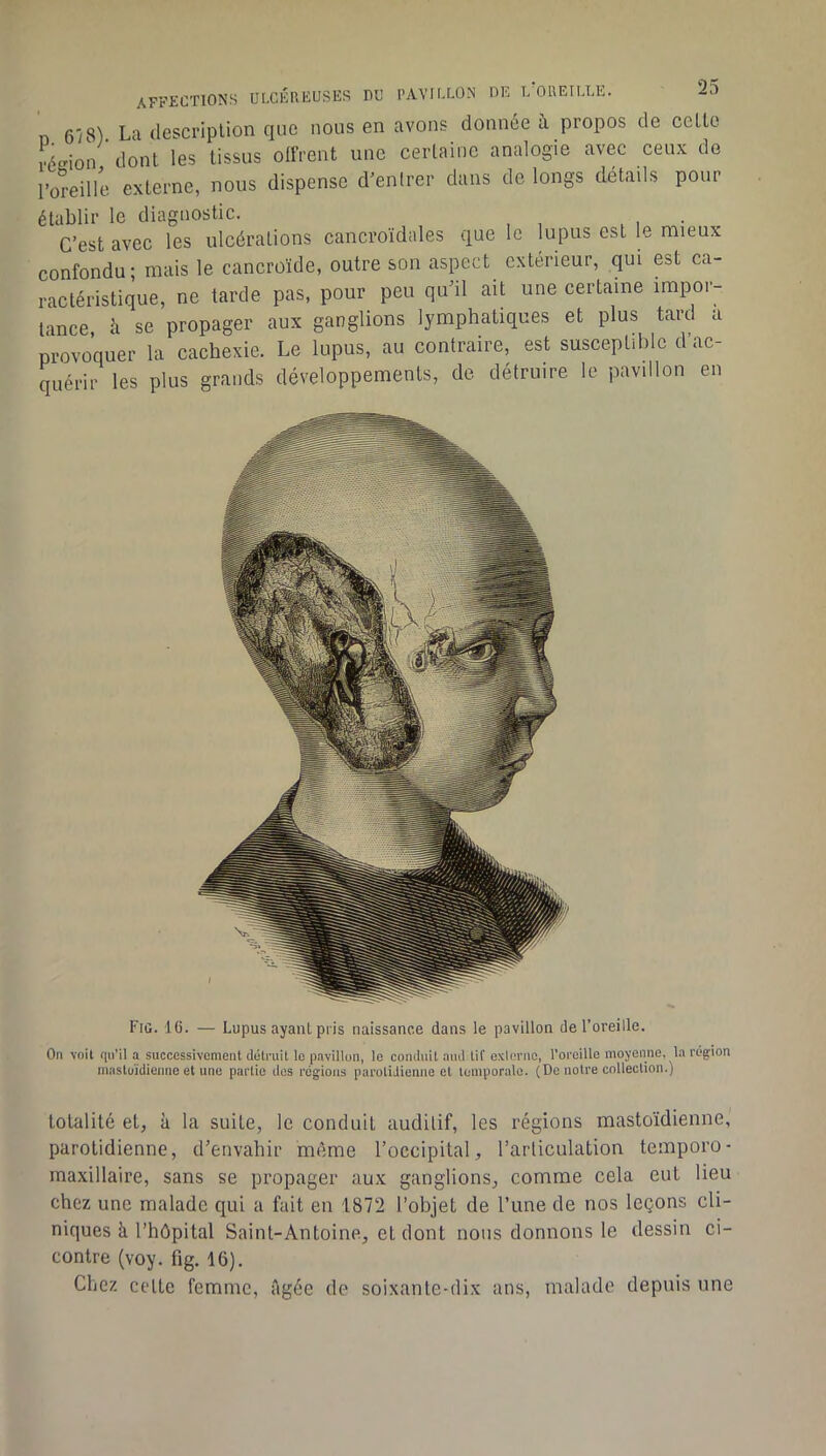 affections IJtXÉP.EUSES DU PAVILLON DE L OREILLE. 6/8) La description que nous en avons donnée à propos de celle vécion dont les tissus olfrent une certaine analogie avec ceux de l’oreille externe, nous dispense d'entrer dans de longs détails pour établir le diagnostic. . C’est avec les ulcérations cancroïdales que le lupus est le mieux confondu; mais le cancroïde, outre son aspect extérieur, qui est ca- ractéristique, ne tarde pas, pour peu qu’il ait une certaine impor- tance à se propager aux ganglions lymphatiques et plus tard a provoquer la cachexie. Le lupus, au contraire, est susceptible d’ac- quérir les plus grands développements, de détruire le pavillon en Fiü. lü. — Lupus ayant pi'is naissance dans le pavillon de l’oreille. On voit qu’il a successivement détruit le p.ivillon, le conduit and lif cxlerno, l’oreille moyenne, la région mastoïdienne et une partie des régions parotidienne et leniporale. (De noire colleclion.) totalité et, à la suite, le conduit auditif, les régions mastoïdienne, parotidienne, d’envahir même l’occipital, l’articulation temporo- maxillaire, sans se propager aux ganglions, comme cela eut lieu chez une malade qui a fait en 1872 l’objet de Tune de nos leçons cli- niques à l’hôpital Saint-Antoine, et dont nous donnons le dessin ci- contre (voy. fig. 16). Chez cette femme, âgée de soixante-dix ans, malade depuis une