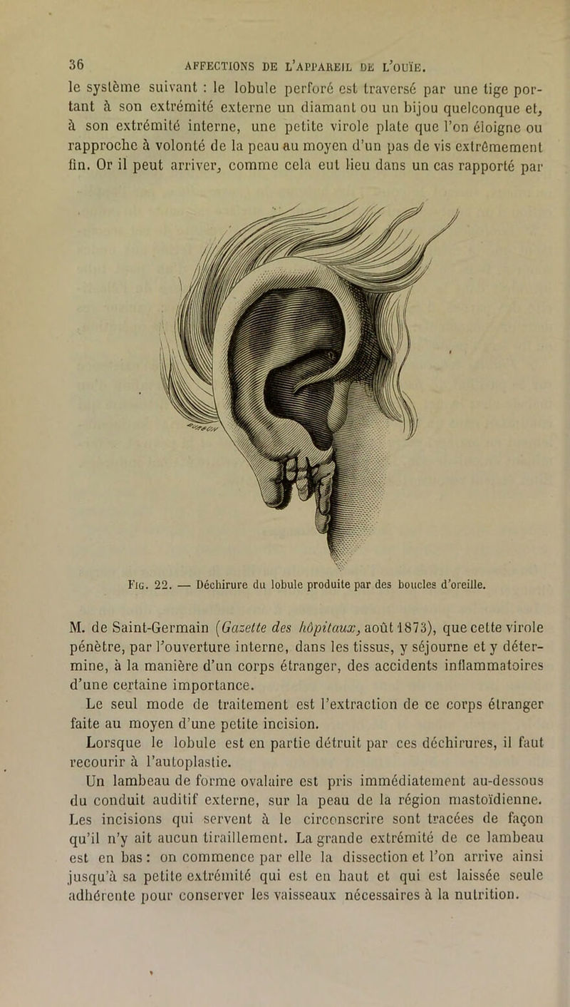 le système suivant : le lobule perforé est traversé par une tige por- tant à son extrémité externe un diamant ou un bijou quelconque et, à son extrémité interne, une petite virole plate que l’on éloigne ou rapproche à volonté de la peau au moyen d’un pas de vis extrêmement fin. Or il peut arriver, comme cela eut lieu dans un cas rapporté par Fig. 22. — Déchirure du lobule produite par des boucles d’oreille. M. de Saint-Germain [Gazette des hôpitaux, août iSTi), que cette virole pénètre, par l’ouverture interne, dans les tissus, y séjourne et y déter- mine, à la manière d’un corps étranger, des accidents inflammatoires d’une certaine importance. Le seul mode de traitement est l’extraction de ce corps étranger faite au moyen d’une petite incision. Lorsque le lobule est en partie détruit par ces déchirures, il faut recourir à l’autoplaslie. Un lambeau de forme ovalaire est pris immédiatement au-dessous du conduit auditif externe, sur la peau de la région mastoïdienne. Les incisions qui servent à le circonscrire sont tracées de façon qu’il n’y ait aucun tiraillement. La grande extrémité de ce lambeau est en bas : on commence par elle la dissection et l’on arrive ainsi jusqu’à sa petite extrémité qui est en haut et qui est laissée seule adhérente pour conserver les vaisseaux nécessaires à la nutrition.