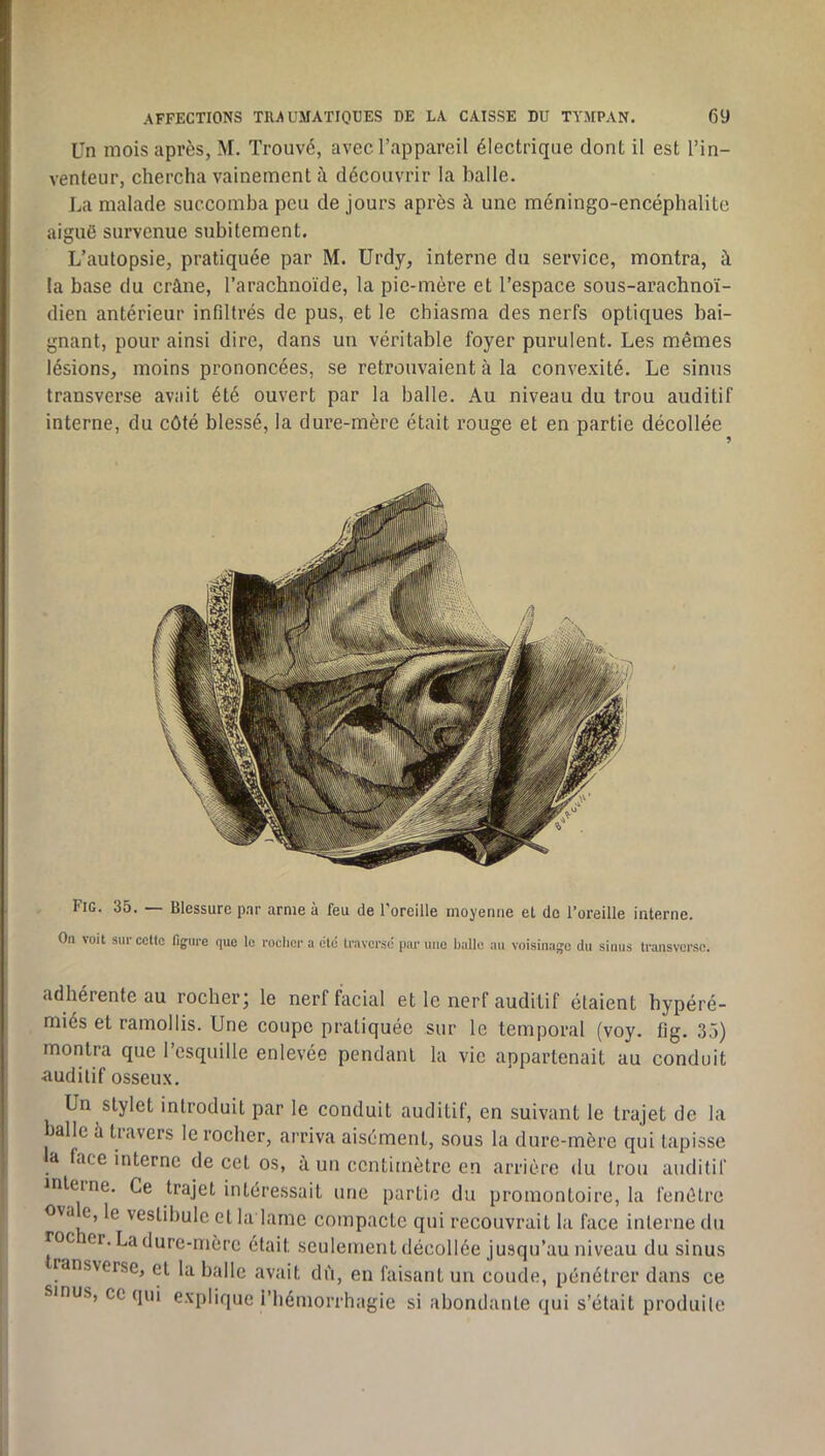 Un mois après, M. Trouvé, avec l’appareil électrique dont il est l’in- venteur, chercha vainement à découvrir la balle. La malade succomba peu de jours après à une méningo-encéphalite aiguë survenue subitement. L’autopsie, pratiquée par M. Urdy, interne du service, montra, à la base du crâne, l’arachnoïde, la pie-mère et l’espace sous-arachnoï- dien antérieur infiltrés de pus, et le chiasma des nerfs optiques bai- gnant, pour ainsi dire, dans un véritable foyer purulent. Les mêmes lésions, moins prononcées, se retrouvaient à la convexité. Le sinus transverse avait été ouvert par la balle. Au niveau du trou auditif interne, du côté blessé, la dure-mère était rouge et en partie décollée Fig. 35. — Blessure p.ir arme à feu de l’oreille inoyemie et de l’oreille interne. On voit sur celte flgiu-e que le rocher a été traverse par une balle au voisinage du sinus transvcrsc. adhérente au rocherj le nerf facial et le nerf auditif étaient hypéré- miés et ramollis. Une coupe pratiquée sur le temporal (voy. lîg. 35) montra que l’esquille enlevée pendant la vie appartenait au conduit auditif osseux. Un stylet introduit par le conduit auditif, en suivant le trajet de la balle à travers le rocher, arriva aisément, sous la dure-mère qui tapisse a face interne de cet os, à un centimètre en arrière du trou auditif inleine. Ce trajet intéressait une partie du promontoire, la fenêtre ovale, le vestibule et la lame compacte qui recouvrait la face interne du roc er. La dure-mère était seulement décollée jusqu’au niveau du sinus ransverse, et la balle avait diï, en faisant un coude, pénétrer dans ce sinus, ce qui explique i’hémorrhagie si abondante qui s’était produite