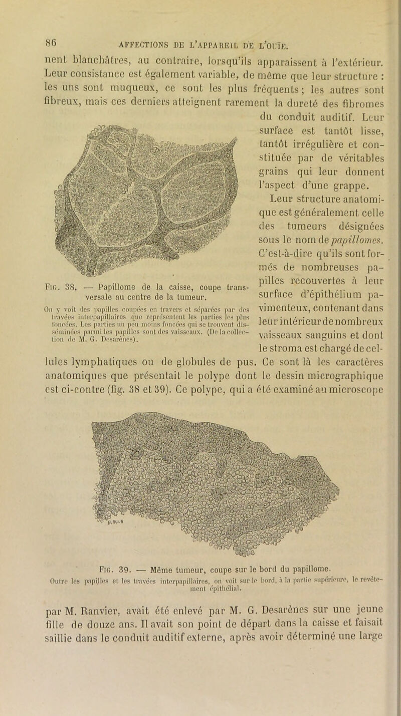 nenl blanchalres, au coiiLrairc, loi’squ’ils apparaissent à l’extériciir. Leur consistance est également variable, de même que leur structure : les uns sont muqueux, ce sont les plus fréquents; les autres sont fibreux, mais ces derniers atteignent rarement la dureté des fibromes du conduit auditif. Leur surface est tantôt lisse, tantôt irrégulière et con- stituée par de véritables grains qui leur donnent l’aspect d’une grappe. Leur structure anatomi- que est généralement celle des tumeurs désignées sous le nom de papillomes. C’est-à-dire qu’ils sont for- més de nombreuses pa- pilles recouvertes à leur surface d’épithélium pa- vimenteux, contenant dans leur intérieur de nombreux vaisseaux sanguins et dont le stroma est chargé de cel- lules lymphatiques ou de globules de pus. Ce sont là les caractères anatomiques que présentait le polype dont le dessin inicrographique est ci-contre (fig. 38 et 39). Ce polype, qui a été examiné au microscope Fir.. 38. — Papillotne de la caisse, coupe trans- versale au centre de la tumeur. On y voit des papilles coiipiies on travers et séparées par dos travées intorpapillairos qno ropré.sontont les parties les pins linirécs. Los parties nn peu moins foncées qui se tronvont dis- séminées parmi les ])apillos sont des vaisseaux. (De la eollee- lion (le i\l. G. Desarènes). Fig. 39. — Môme tumeur, coupe sur le bord du paplllome. Outre les papi.lles et les travées inU'rpapillaires, on voit sur le liord, îi la partie snp(!rienre, le revête- ment épithélial. par M. Ranvier, avait été enlevé par M. G. Desarènes sur une jeune fille de douze ans. Il avait son point de départ dans la caisse et faisait saillie dans le conduit auditif externe, après avoir déterminé une large
