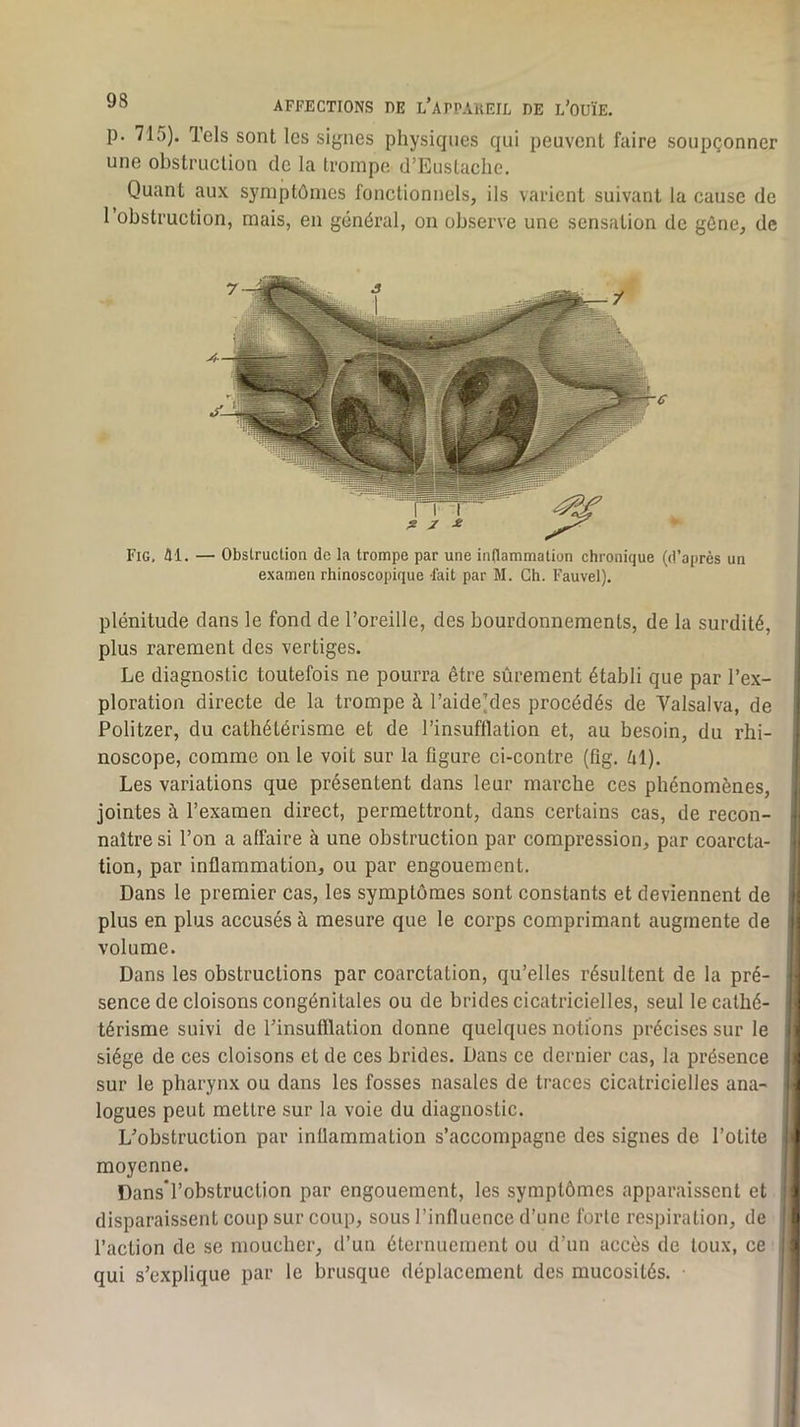 P- 715). Tels sont les signes physiques qui peuvent faire soupçonner une obstruction de la trompe d’Eustaclie. Quant aux symptômes fonctionnels, ils varient suivant la cause de l’obstruction, mais, en général, on observe une sensation de gène, de Fig, Al. — Obstruction de la trompe par une inflammation chronique (d’après un examen rhinoscopique -fait par M. Ch. Fauvel). plénitude dans le fond de l’oreille, des bourdonnements, de la surdité, plus rarement des vertiges. Le diagnostic toutefois ne pourra être sûrement établi que par l’e.x- ploration directe de la trompe à l’aide)des procédés de Valsalva, de Politzer, du cathétérisme et de l’insuftlation et, au besoin, du rhi- noscope, comme on le voit sur la figure ci-contre (fig. Zil). Les variations que présentent dans leur marche ces phénomènes, jointes à l’examen direct, permettront, dans certains cas, de recon- naître si l’on a affaire à une obstruction par compression, par coarcta- tion, par inflammation, ou par engouement. Dans le premier cas, les symptômes sont constants et deviennent de plus en plus accusés à mesure que le corps comprimant augmente de volume. Dans les obstructions par coarctation, qu’elles résultent de la pré- sence de cloisons congénitales ou de brides cicatricielles, seul le cathé- térisme suivi de l’insufflation donne quelques notions précises sur le siège de ces cloisons et de ces brides. Dans ce dernier cas, la présence sur le pharynx ou dans les fosses nasales de traces cicatricielles ana- logues peut mettre sur la voie du diagnostic. L’obstruction par inüammation s’accompagne des signes de l’otite moyenne. Dans'l’obstruction par engouement, les symptômes apparaissent et disparaissent coup sur coup, sous l’influence d’une forte respiration, de l’action de se moucher, d’un éternuement ou d’un accès de toux, ce qui s’explique par le brusque déplacement des mucosités.