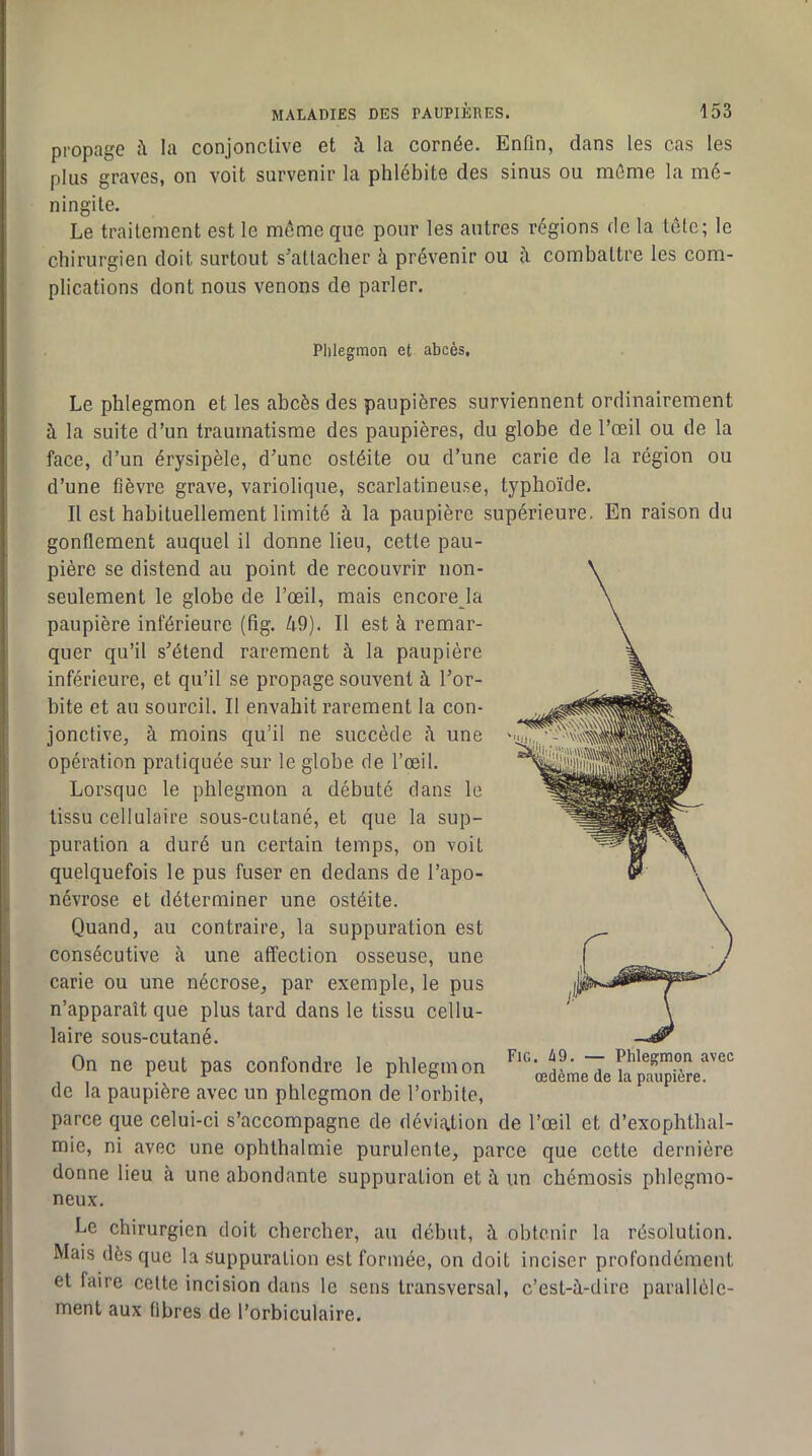 propage la conjonctive et à la cornée. Enfin, dans les cas les plus graves, on voit survenir la phlébite des sinus ou même la mé- ningite. Le traitement est le même que pour les antres régions de la tête; le chirurgien doit surtout s’attacher à prévenir ou à combattre les com- plications dont nous venons de parler. Phlegmon et abcès. Le phlegmon et les abcès des paupières surviennent ordinairement à la suite d’un traumatisme des paupières, du globe de l’œil ou de la face, d’un érysipèle, d’une ostéite ou d’une carie de la région ou d’une fièvre grave, variolique, scarlatineuse, typhoïde. Il est habituellement limité à la paupière supérieure, En raison du gonflement auquel il donne lieu, cette pau- pière se distend au point de recouvrir non- seulement le globe de l’œil, mais encoreja paupière inférieure (fig. ù9). Il est à remar- quer qu’il s’étend rarement à la paupière inférieure, et qu’il se propage souvent à l’or- bite et au sourcil. Il envahit rarement la con- jonctive, à moins qu’il ne succède à une opération pratiquée sur le globe de l’œil. Lorsque le phlegmon a débuté dans le tissu cellulaire sous-cutané, et que la sup- puration a duré un certain temps, on voit quelquefois le pus fuser en dedans de l’apo- névrose et déterminer une ostéite. Quand, au contraire, la suppuration est consécutive à une affection osseuse, une carie ou une nécrose, par exemple, le pus n’apparaît que plus tard dans le tissu cellu- laire sous-cutané. On ne peut pas confondre le phlegmon de la paupière avec un phlegmon de l’orbite, parce que celui-ci s’accompagne de déviation de l’œil et d’exophthal- mie, ni avec une ophlhalmie purulente, parce que cette dernière donne lieu à une abondante suppuration et à un cbémosis pblegmo- neux. Le chirurgien doit chercher, au début, à obtenir la résolution. Mais dès que la Suppuration est formée, on doit inciser profondément et faire cette incision dans le sens transversal, c’est-à-dire parallèle- ment aux fibres de l’orbiculaire. Fie. 49. — Phlegmon avec œdème de la paupière.
