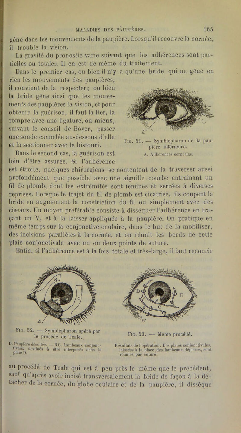 gône clans les mouvements de la paupière. Lorsqu’il recouvre la cornée, il trouble la vision. La gravité du pronostic varie suivant que les adhérences sont par- tielles ou totales. Il en est de môme du traitement. Dans le premier cas, ou bien il n’y a qu’une bride qui ne gêne en rien les mouvements des paupières, il convient de la respecter; ou bien la bride gône ainsi que les mouve- ments des paupières la vision, et pour obtenir la guérison, il faut la lier, la rompre avec une ligature, ou mieu.v, suivant le conseil de Boyer, passer une sonde cannelée au-dessous d’elle et la sectionner avec le bistouri. Dans le second cas, la guérison est loin d’être assurée. Si l’adhérence est étroite, quelques chirurgiens se contentent de la traverser aussi profondément que possible avec une aiguille courbe entraînant un fil de plomb, dont les extrémités sont tendues et serrées à diverses reprises. Lorsque le trajet du fil de plomb est cicatrisé, ils coupent la bride en augmentant la constriction du fil ou simplement avec des ciseaux. Un moyen préférable consiste h disséquer l’adhérence en tra- çant un V, et à la laisser appliquée à la paupière. On pratique en même temps sur la conjonctive oculaire, dans le but de la mobiliser, des incisions parallèles à la cornée, et on réunit les bords de cette plaie conjonctivale avec un ou deux points de suture. Enfin, si l’adhérence est à la fois totale et très-large, il faut recourir Fig. 51. — vSymblépharon de la pau- pière inférieure. A. Adliérences cornéalcs. Fie. 52. — Symblépharon opéré par le procédé de Teale. D. PaupiÎTf'(Ji'colldc. — BC. Latnlicaiix conjonc- tivaux destine» à être interposés dans la plaie I). ‘ Fig. 53. — Môme procédé. Ri'snllals de l’opération. Dos plaies conjonctivales, laissées à la place des lamlicaux déplacés, sont l’éunies par suture. au procédé de Teale qui est à peu près le môme que le ]U'écédent, sauf qii après avoir incisé transversalement la bride de façon à la dé- tacher delà cornée, du globe oculaire et de la paupière, il dissèque