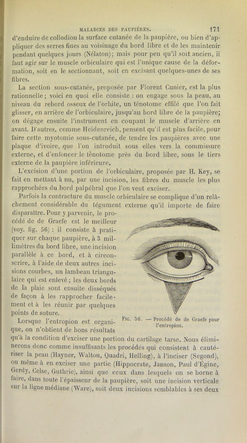 d’enduire de collodion la surface cutanée de la paupière, ou bien d’ap- pliquer des serres fines au voisinage du bord libre et de les maintenir pendant quelques jours (Nélaton); mais pour peu qu’il soit ancien, il faut agir sur le muscle orbiculaire qui est l’unique cause de la défor- mation, soit en le sectionnant, soit en excisant quelques-unes de ses libres. La section sous-cutanée, proposée par Florent Cunicr, est la plus rationnelle ; voici en quoi elle consiste : on engage sous la peau, au niveau du rebord osseux de l’orbite, un ténotome effilé que l’on fait glisser, en arrière de l’orbiculaire, jusqu’au bord libre de la paupière; on dégage ensuite l’instrument en coupant le muscle d’arrière en avant. D’autres, comme Heidenreich, pensent qu’il est plus facile, pour faire cette myotomie sous-cutanée, de tendre les paupières avec une plaque d’ivoire, que l’on introduit sous elles vers la commissure externe, et d’enfoncer le ténotome près du bord libre, sous le tiers externe de la paupière inférieure. L’excision d^’une portion de Forbiculaire, proposée par H. Key, se fait en mettant à nu, par une incision, les fibres du muscle les plus rapprochées du bord palpébral que l’on veut exciser. Parfois la contracture du muscle orbiculaire se complique d’un relâ- chement considérable du tégument externe qu’il importe de faire disparaître. Pour y parvenir, le pro- cédé de de Graefe est le meilleur (voy. fig. 56) : il consiste à prati- quer sur chaque paupière, à 3 mil- limètres du bord libre, une incision parallèle à ce bord, et à circon- scrire, à l’aide de deux autres inci- sions courbes, un lambeau triangu- laire qui est enlevé ; les deux bords de la plaie sont ensuite disséqués de façon à les rapprocher facile- ment et à les réunir par quelques points de suture. Lorsque l’entropion est organi- “ P-’océdé de de Graefe pour ... ° lenlropion. que, on n obtient de bons résultats qu à la condition d’exciser une portion du cartilage tarse. Nous élimi- nerons donc comme insuffisants les procédés qui consistent â cauté- riser la peau (Hayner, Walton, Quadri, Helling), à l’inciser (Segond), ou môme à en exciser une partie (Hippocrate, Janson, Paul d’Ëgine, Oercly, Lclse, Guthrie), ainsi que ceux dans lesquels on se borne à faire, dans toute l’épaisseur de la paupière, soit une incision verticale sur la ligne médiane (Ware), soit deux incisions semblables à ses deux