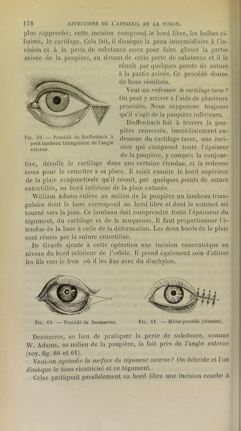 plus rapproché; celle incision comprend le bord libre, les bulbes ci- liaires, le carlibif^e. Gela lail, il dissèque la peau inlermédiaire à l’in- , cision el à la perle de substance assez pour faire glisser la parue avivée de la paupière, au devanl de celle perle de subslancc et il la réunit par quelques points de suture c\ la partie avivée. Ce procédé donne '' de bons résultats. Veut-on rerhesser le cartilage tarse ? On peut y arriver à l’aide de plusieurs procédés. Nous supposons toujours qu’il s’agit de la paupière inférieure. Dieffenbach fait à travers la pau- pière renversée, immédiatement au- dessous du cartilage tarse, une inci- sion qui comprend toute l’épaiseur de la paupière, y compris la conjonc- tive, décolle le cartilage dans une certaine étendue, el le redresse ' assez pour le remettre à sa place. 11 saisit ensuite le bord supérieur de la plaie conjonctivale qu’il réunit, par quelques points de suture entortillée, au bord inférieur de la plaie cutanée. William Adams enlève au milieu de la paupière un lambeau trian- gulaire dont la base correspond au bord libre et dont le sommet est tourné vers la joue. Ce lambeau doit comprendre toute l’épaisseur du ' tégument, du cartilage et de la muqueuse. Il faut proportionner l’é- tendue de la base à celle de la déformation. Les deux bords de la plaie sont réunis par la suture entortillée. De Graefe ajoute à celte opération une incision concentrique au niveau du bord inférieur de l’orbite. Il prend également soin d’attirer les lils vers le fron où il les fixe avec du diachylon. Fig. 59. — Procédé de Dieiïeiibach à petit lambeau triangulaire de l’angle externe. Desmarres, au lieu de pratiquer la perle de substance, comme W. Adams, au milieu de la paupière, la fait près de l’angle externe (voy. fig. 60 el 61). Veut-on agrandir la surface du tégument externe? On débride el l’on dissèque le tissu cicatriciel el ce tégument. Cclse pratiquait parallèlement au bord libre une incision courbe è
