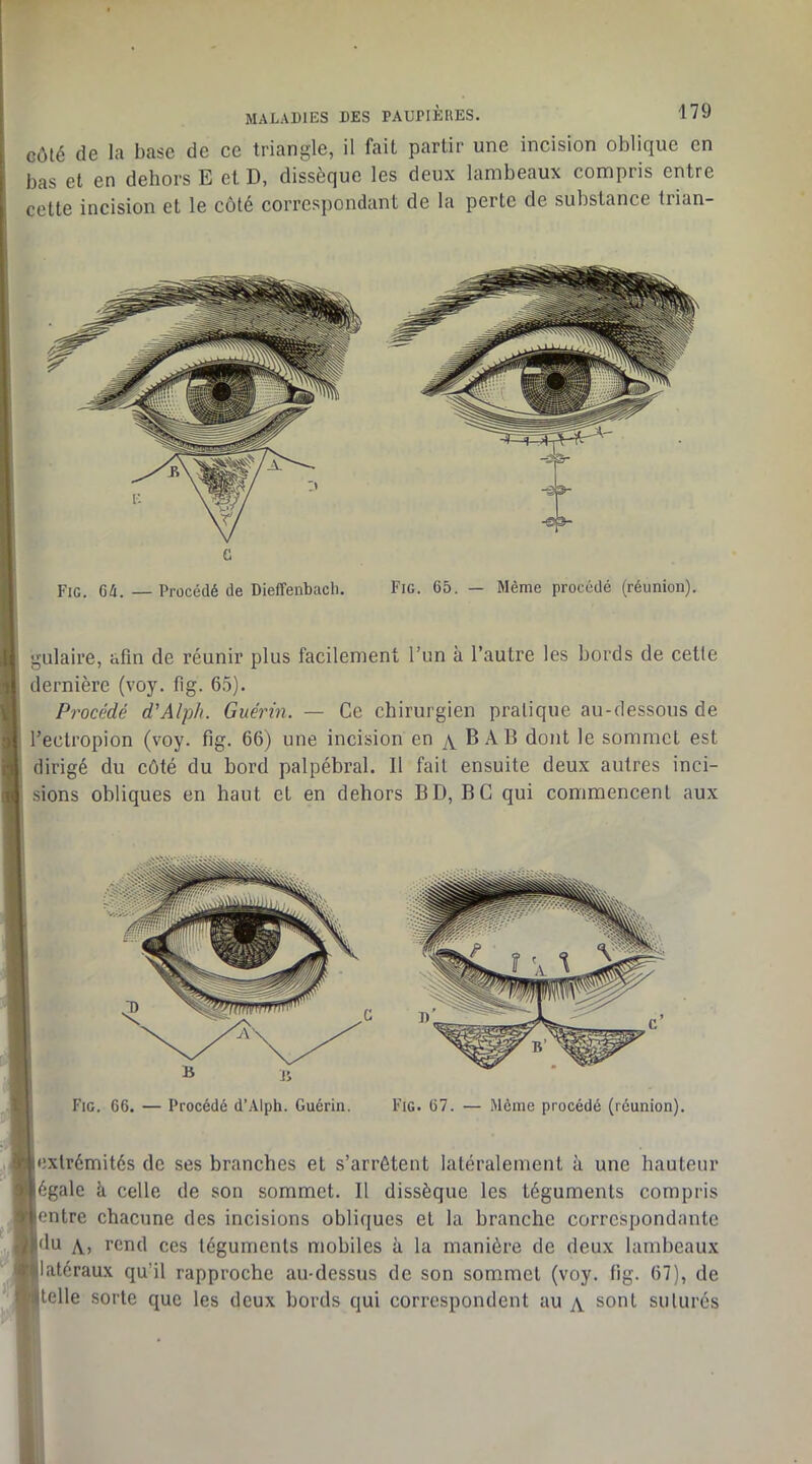 côté de la base de ce triangle, il fait partir une incision oblique en bas et en dehors E et D, dissèque les deux lambeaux compris entre cette incision et le côté correspondant de la perte de substance trian- G Fie. G/i.—Procédé de Dieffenbach. Fig. 65. — Même procédé (réunion). gulaire, afin de réunir plus facilement l’un à l’autre les bords de cette dernière (voy. fig. 6.5). Procédé d’Alph. Guérin. — Ce chirurgien pratique au-dessous de l’ectropion (voy. fig. 66) une incision en B AB dont le sommet est dirigé du côté du bord palpébral. Il fait ensuite deux autres inci- sions obliques en haut et en dehors BD, BC qui commencent aux Fie. 66. — Procédé d’Alph. Guérin. Fig. 67. — Môme procédé (réunion). extrémités de ses branches et s’arrêtent latéralement à une hauteur égale k celle de son sommet. Il dissèque les téguments compris entre chacune des incisions obliques et la branche correspondante du yv, rend ces téguments mobiles à la manière de deux lambeaux latéraux qu’il rapproche au-dessus de son sommet (voy. fig. 67), de telle sorte que les deux hords qui correspondent au a sont suturés