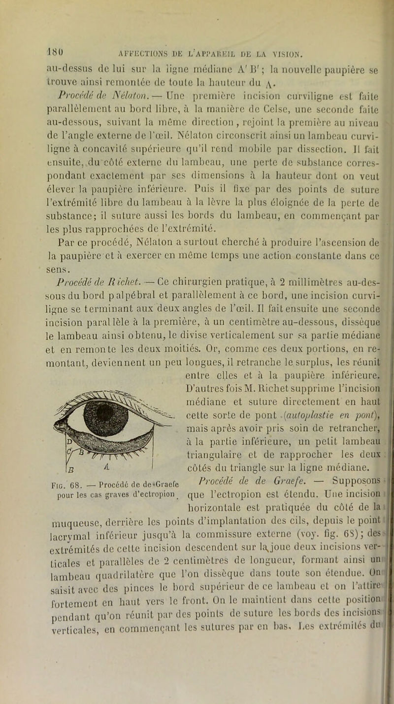 au-dessus de lui sur la ligne médiane A'II’; la nouvelle paupière se trouve ainsi rcmonlèe de toute la hauteur du Procédé de Nélafon.— Une première incision curviligne est faite parallèlement au bord libre, à la manière de Cclse, une seconde faite au-dessous, suivant la même direction , rejoint la première au niveau de l’angle externe de l'œil. Nélaton circonscrit ainsi un lambeau curvi- ligne h concavité supérieure qu’il rend mobile par dissection. Il fait ensuite, du côte externe du lambeau, une perte de substance corres- pondant exactement par ses dimensions à la hauteur dont on veut élever la paupière inférieure. Puis il lixe par des points de suture l’extrémité libre du lambeau à la lèvre la plus éloignée de la perte de substance; il suture aussi les bords du lambeau, en commençant par les plus rapprochées de l’extrémité. Par ce procédé, Nélaton a surtout cherché à produire l’ascension de la paupière et à exercer en même temps une action constante dans ce sens. Procédé de Richet. — Ce chirurgien pratique, 2 millimètres au-des- sous du bord palpébral et parallèlement à ce bord, une incision curvi- ligne SC terminant aux deux angles de l’œil. Il fait ensuite une seconde incision parallèle à la première, è un centimètre au-dessous, dissèque le lambeau ainsi obtenu, le divise verticalement sur .«a partie médiane et en remonte les deux moitiés. Or, comme ces deux portions, en re- montant, deviennent un peu longues, il retranche le surplus, les réunit entre clics et à la paupière inférieure. D’autres fois M. Richet supprime l’incision médiane et suture directement en haut cette sorte de pont .{autoplastie en pont), mais après avoir pris soin de retrancher, à la partie inférieure, un petit lambeau triangulaire et de rapprocher les deux côtés du triangle sur la ligne médiane. Pi'océdé de de Graefe. — Supposons que l’ectropion est étendu. Une incision horizontale est pratiquée du côté de la muqueuse, derrière les points d’implantation des cils, depuis le point lacrymal inférieur jusqu’à la commissure externe (voy. fig. 6S); des extrémités de cette incision descendent sur lîçjouc deux incisions ver- ticales et parallèles de 2 centimètres de longueur, formant ainsi un lambeau quadrilatère que l’on dissèque dans toute son étendue. On saisit avec des pinces le bord supérieur de ce lambeau et on l’attire fortement en haut vers le front, ün le maintient dans cette position pendant qu’on réunit par des points de suture les bords des incisions verticales, en commençant les sutures par en bas. Des extrémités du Fig. 68. — Procédé de de*Graefe pour les cas graves d’ectropion