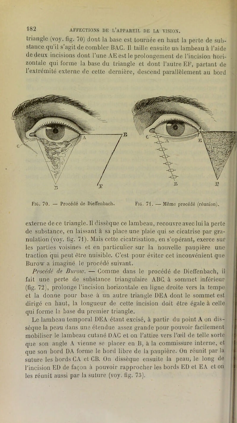 Iriangle (voy. fig. 70) tlonl la base est lournée en haut la perle de sub- stance qu’il s’agit de combler BAC. Il taille ensuite un lambeau à l’aide de deux incisions dont l’une AE est le prolongement de l’incision hori- zontale qui forme la base du triangle et dont l’autre EP, partant de l’extrémité externe de celle dernière, descend parallèlement au bord externe de ce lriangle.il dissèque ce lambeau, recouvre avec lui la perle de substance, en laissant à sa place une plaie qui se cicatrise par gra- nulation (voy. fig. 71). Mais cette cicatrisation, en s’opérant, exerce sur les parties voisines et en particulier sur la nouvelle paupière une traction qui peut être nuisible. C’est pour éviter cet inconvénient que Burow a imaginé le procédé suivant. Procédé de Burow. — Comme dans le procédé de Dieflênbacb, il fait une perte de substance triangulaire ABC à sommet inférieur (fig. 72), prolonge l’incision horizontale en ligne droite vers la tempe et la donne pour base à un autre Iriangle OE.-V dont le sommet est dirigé en haut, la longueur de cette incision doit être égale à celle qui forme la base du premier triangle. Le lambeau temporal DE.A étant excisé, à partir du point A on dis- sèque la peau dans une étendue assez grande pour pouvoir facilement mobiliser le lambeau cutané DAC et on l’attire vers l’œil de telle sorte que son angle A vienne sc placer en B, à la commissure interne, et que son bord DA forme le bord libre de la paupière. On réunit par la suture les bords CA et CB. ün dissèque ensuite la peau, le long de l'incision ED de façon à pouvoir rapprocher les bords ED et E.A et on les réunit aussi par la suture (voy. fig. 73). Fig. 70. — Procédé de Dieffenbach Fig. 71. — Même procédé (réunion).