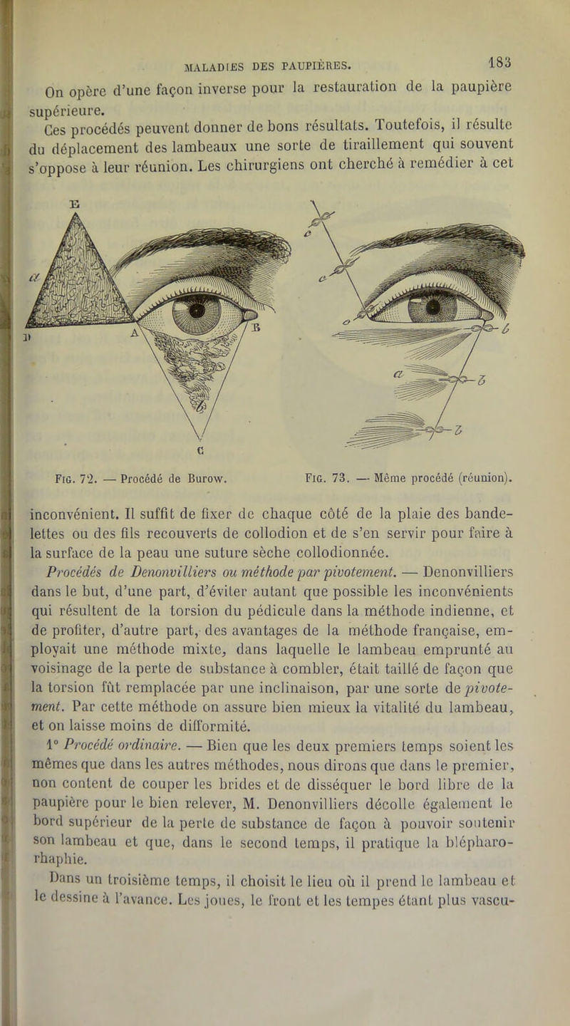 On opère d’une façon inverse pour la restauration de la paupière i supérieure. Ces procédés peuvent donner de bons résultats. Toutefois, il résulte {J du déplacement des lambeaux une sorte de tiraillement qui souvent I s’oppose à leur réunion. Les chirurgiens ont cherché à remédier à cet I I .1 9 S > 'i l< y i a c Fig. 11. — Procédé de Burow. Fig. 73. — Même procédé (réunion). inconvénient. Il suffit de fixer de chaque côté de la plaie des bande- lettes ou des fils recouverts de collodion et de s’en servir pour faire à la surface de la peau une suture sèche collodionnée. Procédés de Denonvilliers ou méthode par pivotement. — Denonvilliers dans le but, d’une part, d’éviter autant que possible les inconvénients qui résultent de la torsion du pédicule dans la méthode indienne, et de profiter, d’autre part, des avantages de la méthode française, em- ployait une méthode mixte, dans laquelle le lambeau emprunté au voisinage de la perte de substance à combler, était taillé de façon que la torsion fût remplacée par une inclinaison, par une sorte de pivote- ment. Par cette méthode on assure bien mieux la vitalité du lambeau, et on laisse moins de dilformité. 1“ Procédé ordinaire. — Bien que les deux premiers temps soient les mêmes que dans les autres méthodes, nous dirons que dans le premier, non content de couper les brides et de disséquer le bord libre de la paupière pour le bien relever, M. Denonvilliers décolle également le bord supérieur de la perle de substance de façon à. pouvoir soutenir son lambeau et que, dans le second temps, il pratique la blépharo- rhaphie. Dans un troisième temps, il choisit le lieu où il prend le lambeau et le dessine à l’avance. Les jones, le front et les tempes étant plus vascu-