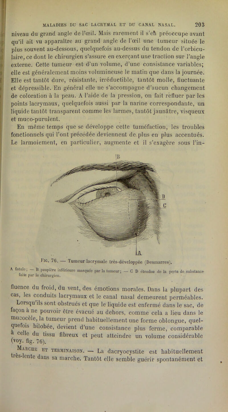 niveau du grand angle de l’œil. Mais rarement il s’efi préoccupe avant qu’il ait vu apparaître au grand angle de l’œil une tumeur située le plus souvent au-dessous, quelquefois au-dessus du tendon de l’orbicu- laire, ce dont le chirurgien s’assure en exerçant une traction sur l’angle externe. Cette tumeur est d’un volume, d’une consistance variables; elle est généralement moins volumineuse le matin que dans la journée. Elle est tantôt dure, résistante, iri’éductible, tantôt molle^ fluctuante et dépressible. En général elle ne s’accompagne d’aucun changement de coloration à la peau. A l’aide de la pression, on fait refluer par les points lacrymaux, quelquefois aussi par la narine correspondante, un liquide tantôt transparent comme les larmes, tantôt jaunâtre, visqueux et muco-purulent. En même temps que se développe cette tuméfaction, les troubles fonctionnels qui l’ont précédée deviennent de plus en plus accentués. Le larmoiement, en particulier, augmente et il s’exagère sous l’in- A. l'iG. 76. — Tumeur lacrymale très-développée (Desmarres). A Gstiilc, B paupière inférieure masquée parla tumeur; — CD étendue de la perte de substance- faite par le chirurgien. fluence du froid, du vent, des émotions morales. Dans la plupart des cas, les conduits lacrymaux et le canal nasal demeurent perméables. Lorsqu ils sont obstrués et que le liquide est enfermé dans le sac, de açon à ne pouvoir être évacué au dehors, comme cela a lieu dans le nau,.,ocèle, la tumeur prend habituellement une forme oblongue, quel- quefois bilobée, devient d’une consistance plus ferme, comparable celle du tissu fibreux et peut atteindre un volume considérable (voy. fig. 76). Marche et terminaison. — La dacryocystite est habituellement T s ente dans sa marche. Tantôt elle semble guérir spontanément et