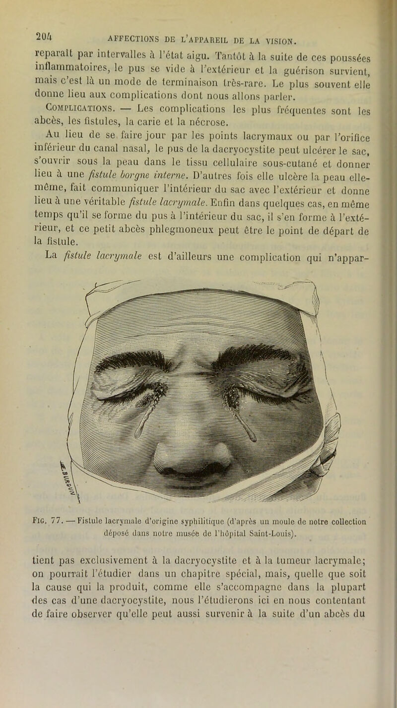 reparaît par intervalles à l’état aigu. Tantôt à la suite de ces poussées inflammatoires, le pus se vide à l’extérieur et la guérison survient, mais c’est là un mode de terminaison très-rare. Le plus souvent elle donne lieu aux complications dont nous allons parler. Complications. — Les complications les jilus fréquentes sont les abcès, les fistules, la carie et la nécrose. Au lieu de se faire jour par les points lacrymaux ou par Torifice inférieur du canal nasal, le pus de la dacryocystite peut ulcérer le sac, s’ouvrir sous la peau dans le tissu cellulaire sous-cutané et donner lieu à une fistule borgne interne. D’autres fois elle ulcère la peau elle- môrne, fait communiquer l’intérieur du sac avec l’extérieur et donne lieu à une véritable fistule lacrymale. Enfin dans quelques cas, en même temps qu’il se forme du pus à l’intérieur du sac, il s’en forme à l’exté- rieur, et ce petit abcès phlegrnoneux peut être le point de départ de la fistule. La fistule lacrymale est d’ailleurs une complication qui n’appar- Fic. 77. — Fistule lacrymale d’origine syphilitique (d’après un moule de notre collection déposé dans notre musée de l’hôpital Saint-Louis). tient pas exclusivement à la dacryocystite et à la tumeur lacrymale; on pourrait l’étudier dans un chapitre spécial, mais, quelle que soit la cause qui la produit, comme elle s’accompagne dans la plupart des cas d’une dacryocystite, nous l’étudierons ici en nous contentant de faire observer qu’elle peut aussi survenir à la suite d’un abcès du