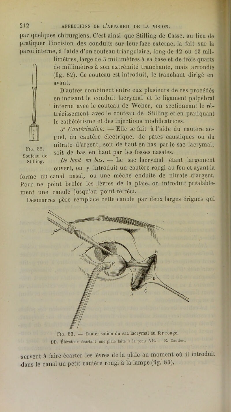 Fie. 83. — Cautérisation du sac lacrymal au fer rouge. DD. Élévateur écartant une plaie faite à la peau AB. — E. Cautère. servent à faire écarter les lèvres de la plaie au moment où il introduit dans le canal un petit cautère rougi à la lampe (fig. 83). 212 AFFECTIONS DE l’aPPaREIL DE T.A VISION. par quelques chirurgiens. C'est ainsi que Stilling de Casse, au lieu de pratiquer l’incision des conduits sur leur face externe, la fait sur la paroi interne, à l’aide d’un couteau triangulaire, long de 12 ou 13 mil- limètres, large de 3 millimètres à sa base et de trois quarts de millimètres à son extrémité tranchante, mais arrondie (fig. 82). Ce couteau est introduit, le tranchant dirigé en avant. D’autres combinent entre eux plusieurs de ces procédés en incisant le conduit lacrymal et le ligament palpébral interne avec le couteau de Weber, en sectionnant le ré- trécissement avec le couteau de Stilling et en pratiquant le cathétérisme et des injections modificatrices. 3“ Cautérisation. — Elle se fait à l’aide du cautère ac- tuel, du cautère électrique, de pûtes caustiques ou du nitrate d’argent, soit de haut en bas parle sac lacrymal, soit de bas en haut par les fosses nasales. De haut en bas. — Le sac lacrymal étant largement ouvert, on y introduit un cautère rougi au feu et ayant la forme du canal nasal, ou une mèche enduite de nitrate d’argent. Pour ne point brûler les lèvres de la plaie, on introduit préalable- ment une canule jusqu’au point rétréci. Desmarres père remplace cette canule par deux larges érignes qui FiG. 82. Couteau de Stilling.