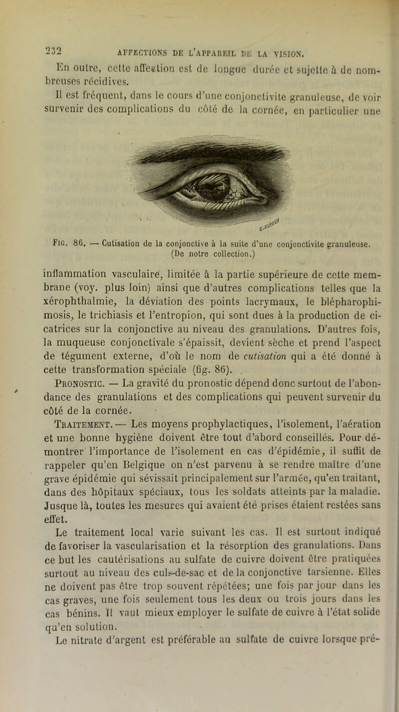 En oulro, celle afleelion est de longue durée et sujette à de nom- breuses récidives. Il est fréquent, dans le cours d’une conjonctivite granuleuse, de voir survenir des complications du coté de la cornée, en particulier une Fig, 86. — Cutisation de la conjonctive à la suite d’une conjonctivite granuleuse. (De notre collection.) inflammation vasculaire, limitée à la partie supérieure de cette mem- brane (voy. plus loin) ainsi que d’autres complications telles que la xérophthalmie, la déviation des points lacrymaux, le blépharophi- mosis, le trichiasis et l’entropion, qui sont dues à la production de ci- catrices sur la conjonctive au niveau des granulations. D’autres fois, la muqueuse conjonctivale s’épaissit, devient sèche et prend l’aspect de tégument externe, d’où le nom de cutisation qui a été donné à cette transformation spéciale (fig. 86). Pronostic. — La gravité du pronostic dépend donc surtout de l’abon- dance des granulations et des complications qui peuvent survenir du côté de la cornée. Traitement.— Les moyens prophylactiques, l’isolement, l’aération et une bonne hygiène doivent être tout d’abord conseillés. Pour dé- montrer l’importance de l’isolement en cas d’épidémie, il suffit de rappeler qu’en Belgique on n’est parvenu à se rendre maître d’une grave épidémie qui sévissait principalement sur l’armée, qu’en traitant, dans des hôpitaux spéciaux, tous les soldats atteints par la maladie. Jusque là, toutes les mesures qui avaient été prises étaient restées sans effet. Le traitement local varie suivant les cas. Il est surtout indiqué de favoriser la vascularisation et la résorption des granulations. Dans ce but les cautérisations au sulfate de cuivre doivent être pratiquées surtout au niveau des culs-de-sac et de la conjonctive tarsienne. Elles ne doivent pas être trop souvent répétées; une fois par jour dans les cas graves, une fois seulement tous les deux ou trois jours dans les cas bénins. 11 vaut mieux employer le sulfate de cuivre à l’état solide qu’en solution. Le nitrate d’argent est préférable au sulfate de cuivre lorsque pré-