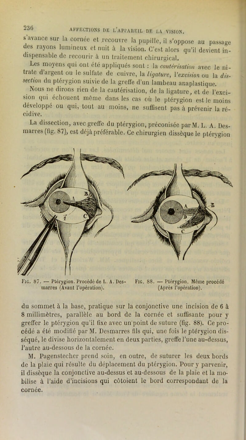 s’avance sur la cornée et recouvre la pupille, il s’oppose au passage des rayons lumineux et nuit à la vision. C’est alors qu’il devient in- dispensable de recourir il un traitement chirurgical. Les moyens qui ont été appliqués sont : la cautérisation avec le ni- trate d argent ou le sultatc de cuivre, la ligature, Vexcision ou la dis- section du ptérygion suivie de la grelle d’un lambeau anaplastique. Nous ne dirons rien de la cautérisation, de la ligature, et de l’exci- sion qui échouent môme dans les cas o(i le ptérygion est le moins développé ou qui, tout au moins, ne suffisent pas à prévenir la ré- cidive. La dissection, avec greffe du ptérygion, préconisée parM. L. A. Des- marres (tig. 87), est déjà préférable. Ce chirurgien dissèque le ptérygion Fig. 87. — Ptérygion. Procédé de L. A. Des- Fig. 88. — Ptérygion. Même procédé marres (Avant l’opération). (Après l’opération). du sommet à la base, pratique sur la conjonctive une incision de 6 à 8 millimètres, parallèle au bord de la cornée et suffisante pour y greffer le ptérygion qu’il lixe avec un point de suture (fig, 88). Ce pro- cédé a été modiüé par M. Desmarres fils qui, une fois le ptérygion dis- séqué, le divise horizontalement en deux parties, greffe l’une au-dessus, l’autre au-dessous de la cornée. M. Pagenstechcr prend soin, en outre, de suturer les deux bords de la plaie qui résulte du déplacement du ptérygion. Pour y parvenir, il dissèque la conjonctive au-dessus et au-dessous de la plaie et la mo- bilise à l’aide d’incisions qui côtoient le bord correspondant de la cornée.
